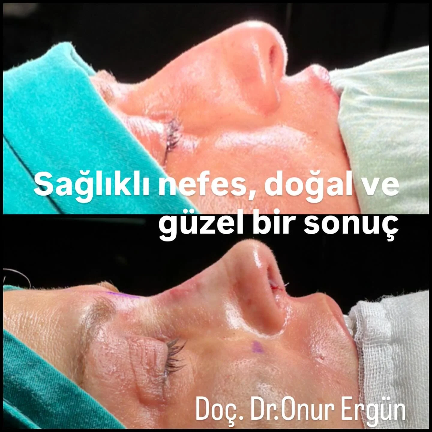 Rahat nefes alamayan ve burun şeklinden de rahatsız olan hastam y&uuml;z&uuml;ne uygun, doğal, g&uuml;zel ve sağlıklı nefes alabilen bir buruna kavuştu&hellip;Piezo cerrahisi, dikkatli kanama kontrol&uuml; ve alınan diğer bir&ccedil;ok &ouml;nlemle a