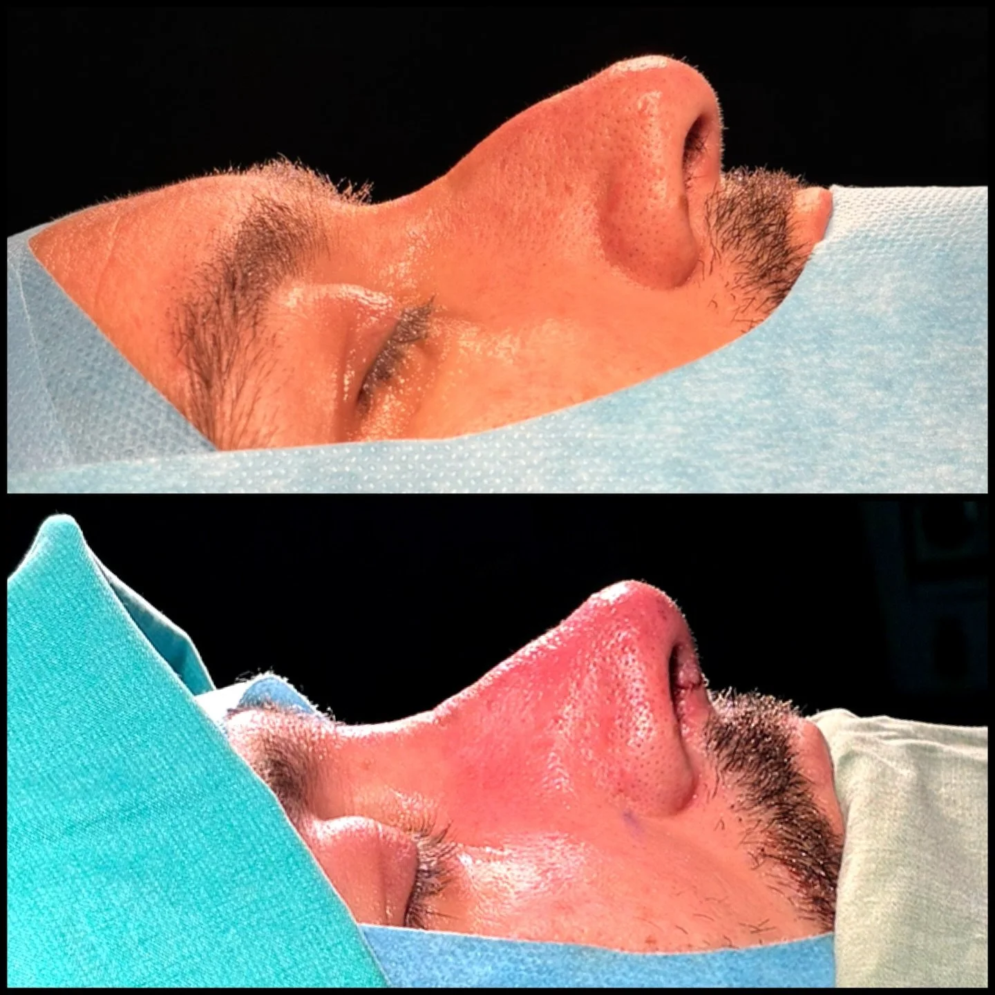 Travmaya bağlı burun orta perdesinde eğrilik, dış aksta kayma ve kıkırdak hasarı olan hastamızın burun tıkanıklığı sorununu giderirken g&ouml;r&uuml;n&uuml;m i&ccedil;in de doğallıktan ayrılmamak koşuluyla bazı &ouml;nemli dokunuşlar yaptık&hellip;👍