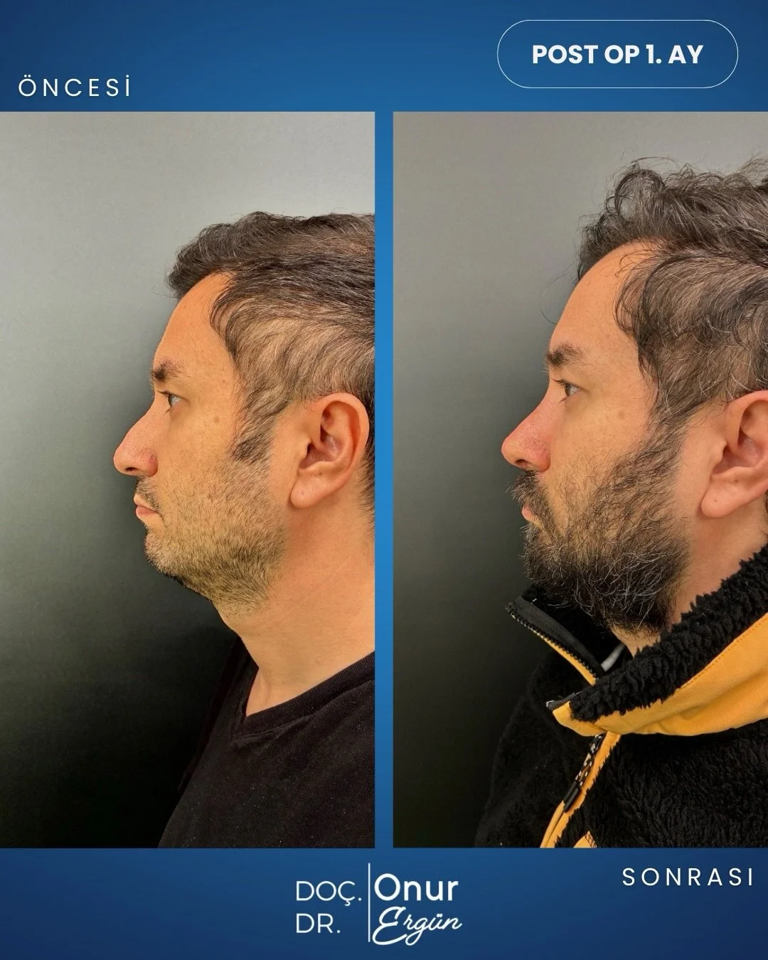 Erkeklerde burun estetiği sadece g&ouml;r&uuml;n&uuml;m değil, aynı zamanda fonksiyonel bir iyileşme s&uuml;recidir. 💪👃

Kalın cilt yapısına sahip erkek hastalarımızda temel hedefimiz; sağlıklı bir nefes yolunun yanı sıra, y&uuml;ze karakter katan 