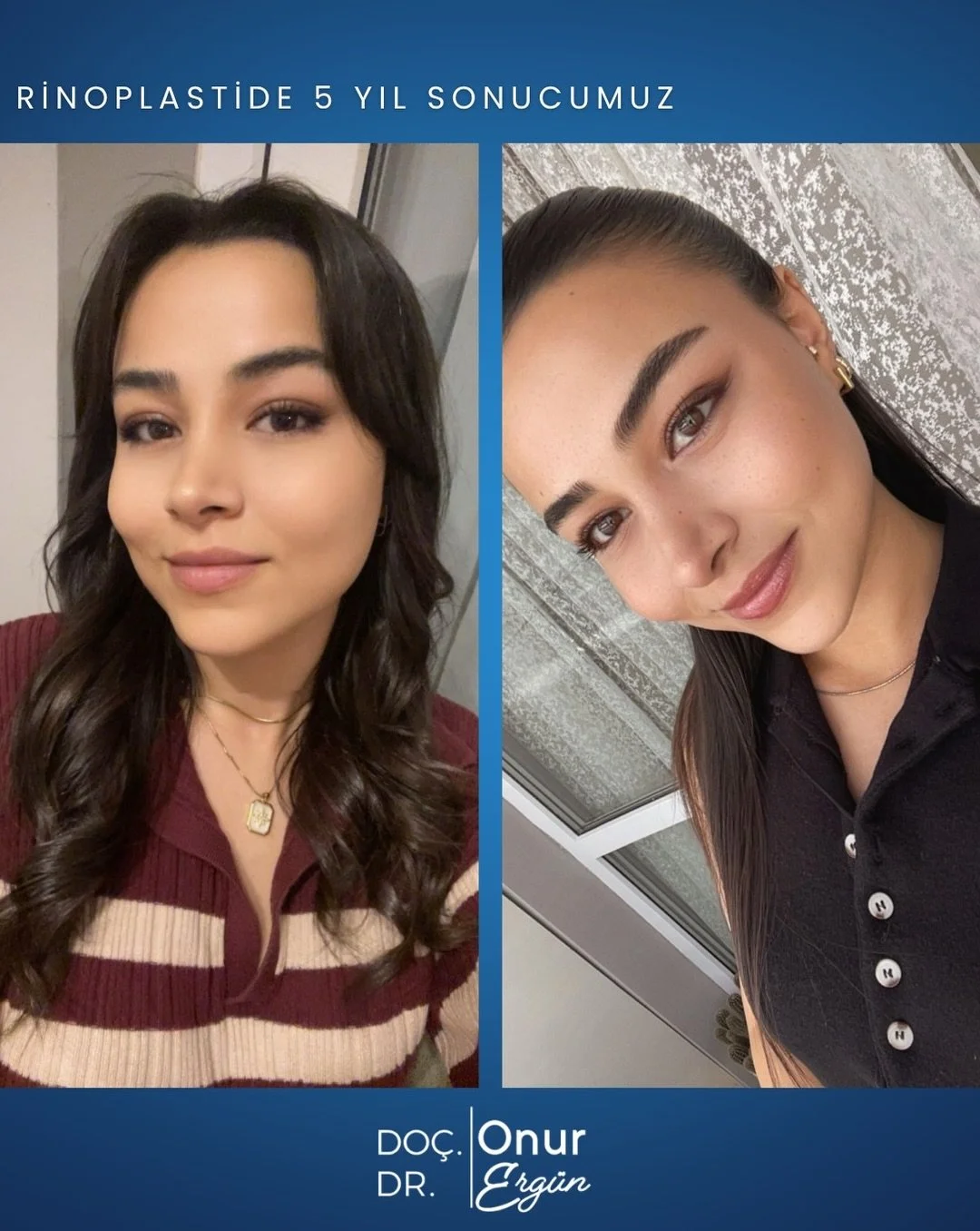 RİNOPLASTİDE 5 YIL SONRA

Burun fonksiyonuna ve anatomisine saygılı, abartıdan uzak cerrahi yaklaşımın 5 yıl sonraki sonucu: doğal g&ouml;r&uuml;n&uuml;m ve sağlıklı nefes.

Do&ccedil;. Dr. Onur Erg&uuml;n
Kulak Burun Boğaz (KBB) Uzmanı
📍 Acıbadem B