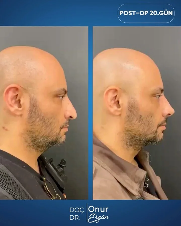 RİNOPLASTİ SONRASI 20. G&Uuml;N 👃

Ameliyat sonrası 20. g&uuml;n&uuml;nde hastamızda doğal, d&uuml;zg&uuml;n ve g&uuml;&ccedil;l&uuml; bir burun g&ouml;r&uuml;n&uuml;m&uuml; elde ettik.

Rinoplastide amacımız yalnızca estetik a&ccedil;ıdan g&uuml;ze