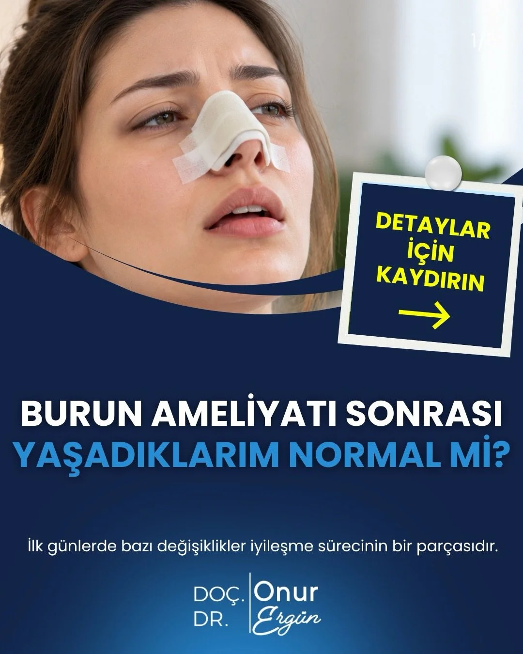 BURUN AMELİYATI SONRASI YAŞADIKLARIM NORMAL Mİ? 👃

Burun ameliyatı sonrasında tıkanıklık, şişlik, morluk ve hafif kanlı akıntı gibi belirtiler g&ouml;r&uuml;lebilir. Bunların bir&ccedil;oğu iyileşme s&uuml;recinin doğal bir par&ccedil;asıdır. Ancak 