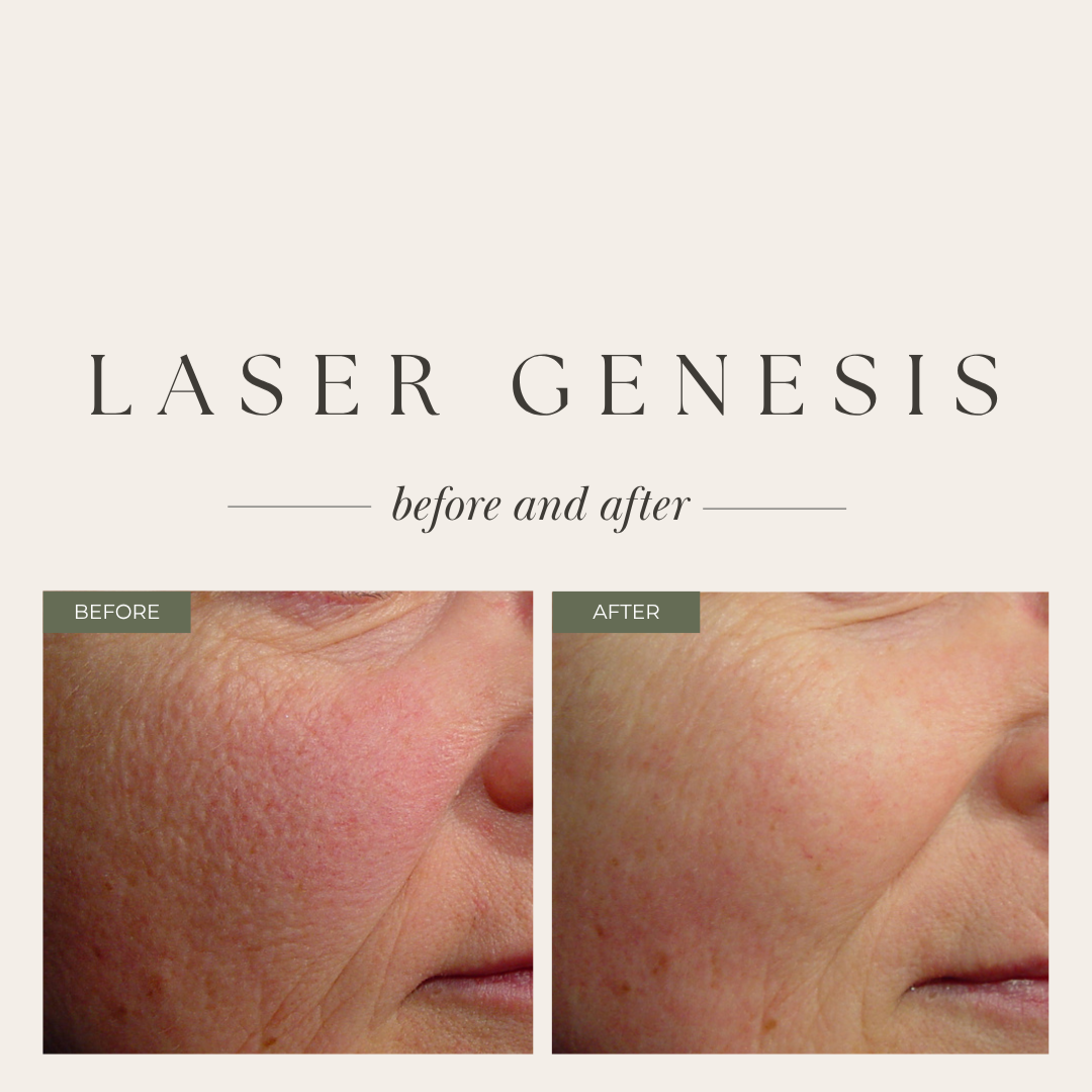 Laser genesis before and after 