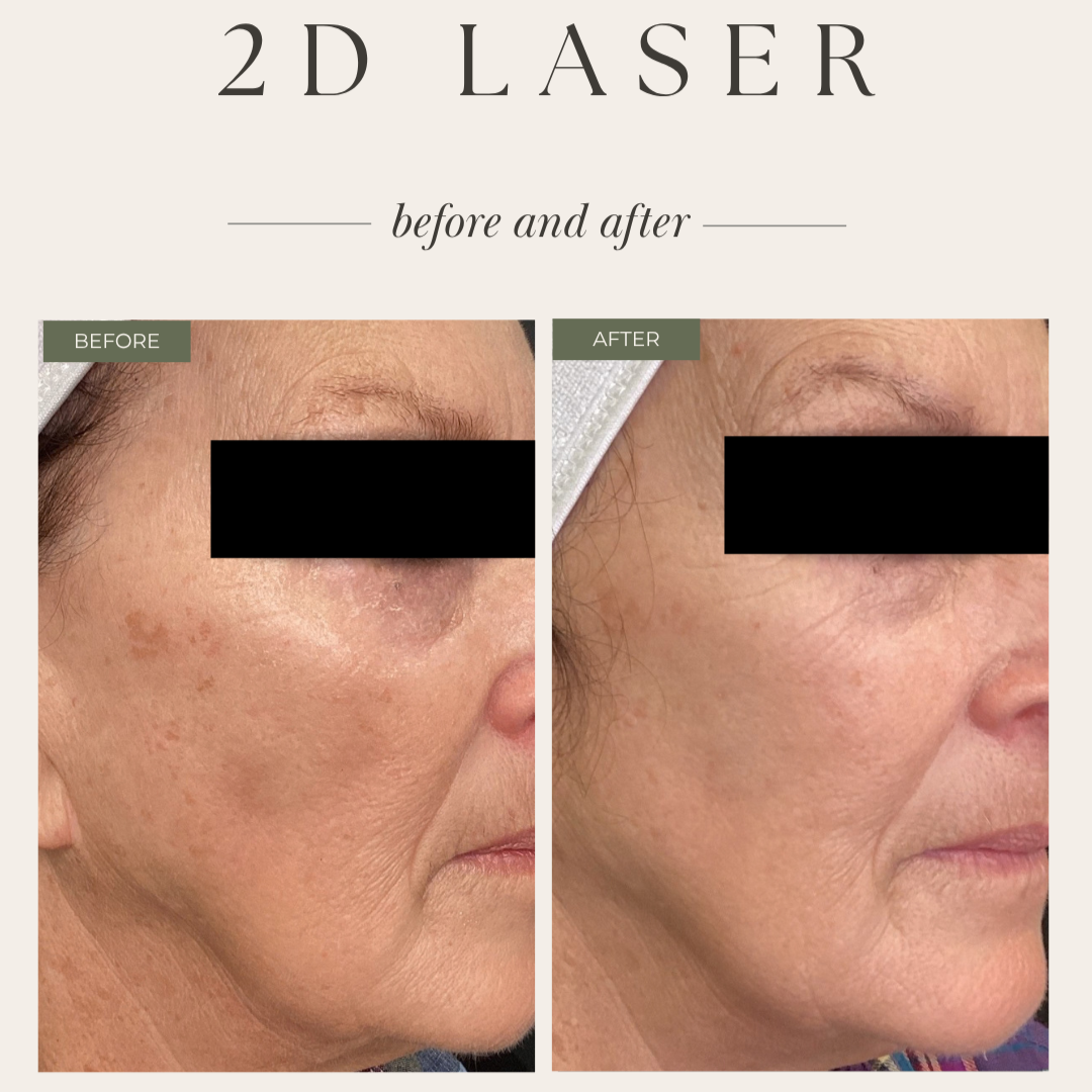 laser genesis and limelight ipl combo therapy before and after