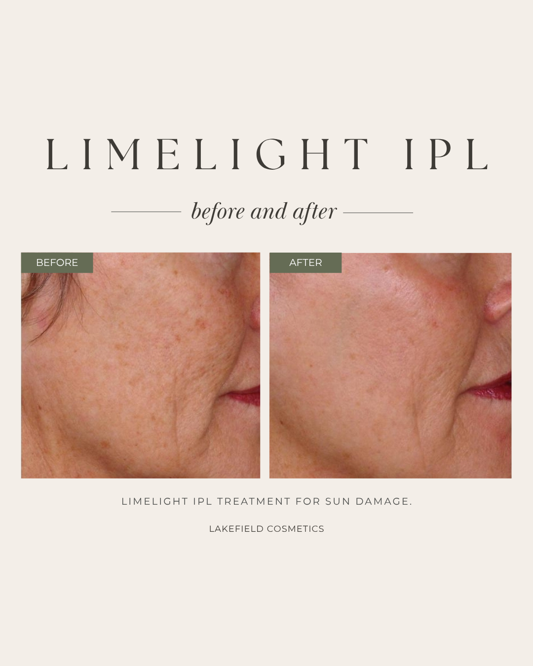 Limelight IPL before and after sun damage lakefield