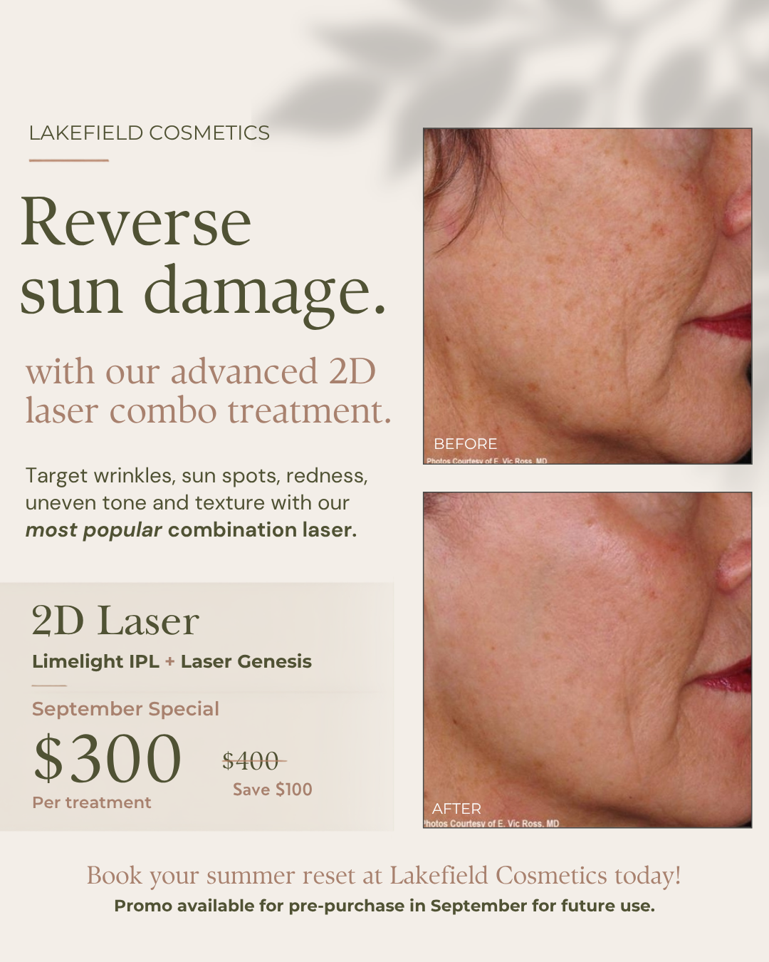 Reverse Summer Skin Damage with our 2D Laser Promo- Now only $300 per session (reg. $400)