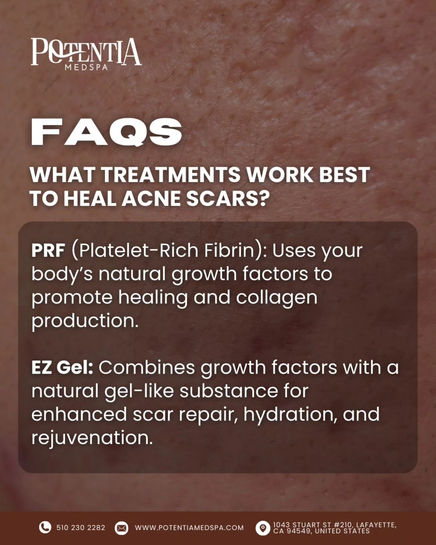 ✨ What&rsquo;s the Best Way to Treat Scars? ✨

At Potentia Medspa, we offer advanced solutions to help you achieve smoother, healthier-looking skin:

💉 PRF (Platelet-Rich Fibrin): Uses your body&rsquo;s natural growth factors to boost healing, colla