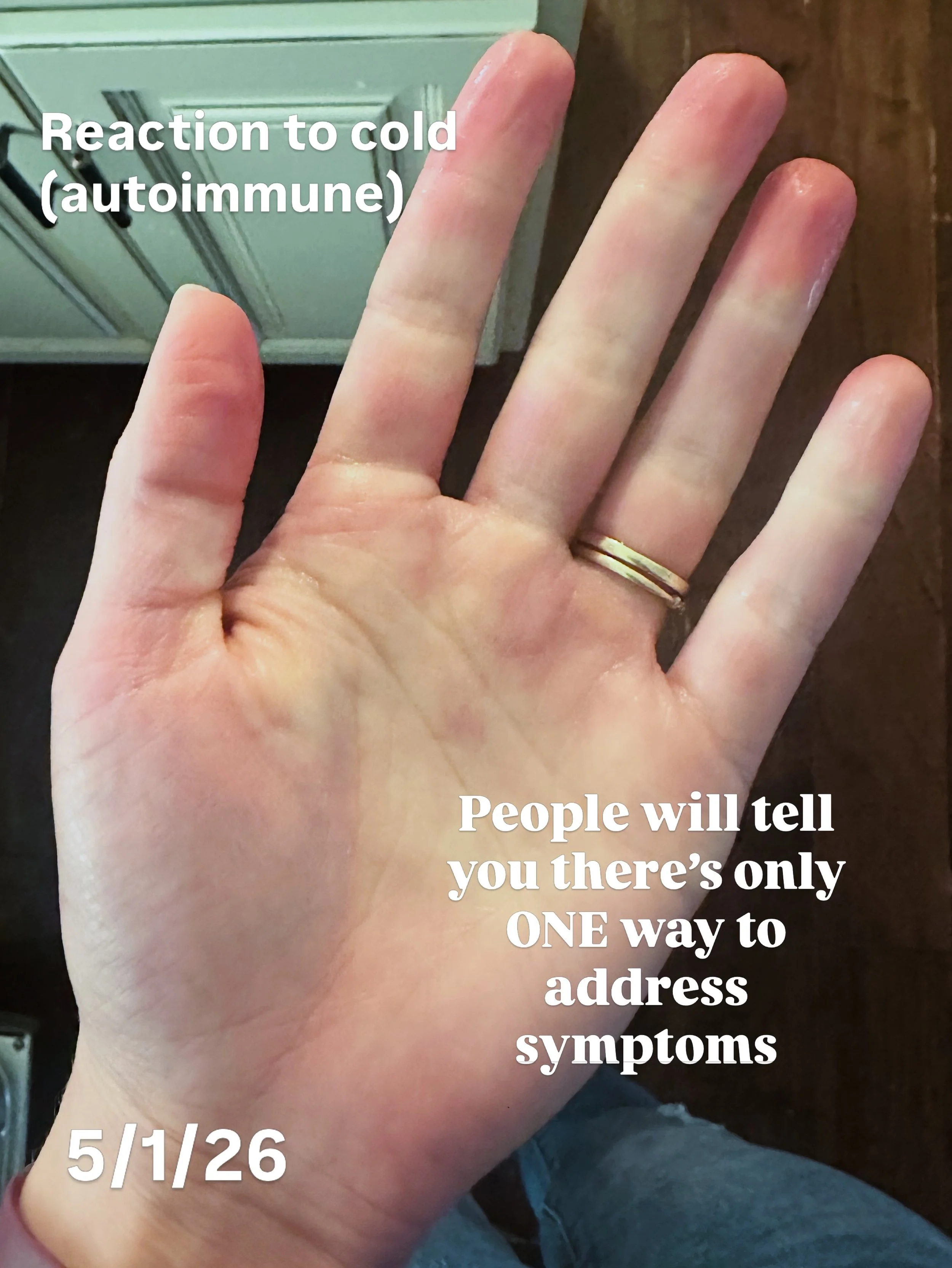 Filter enhancement so you can better see what my phone camera doesn&rsquo;t fully pick up the way it looked in person. The color changes and vascular reactions were much more noticeable in real life.

After my body went into significant autonomic ner