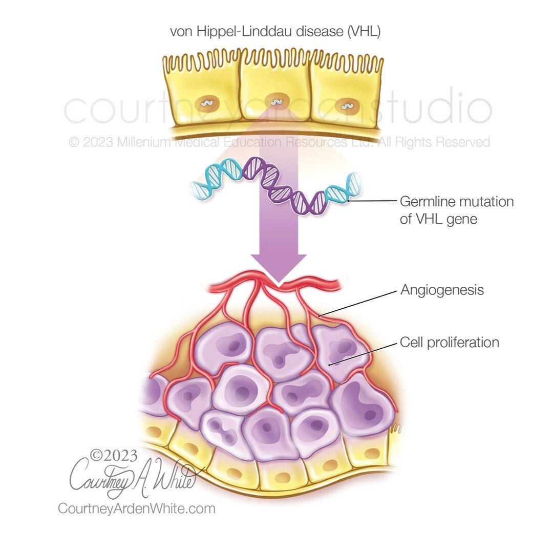 In a previous post, I shared a set of illustrations that were part of a patient education booklet about the kidneys and kidney diseases. These illustrations were a part of that same booklet. The first two illustrations explain von Hippel-Lindau (VHL)