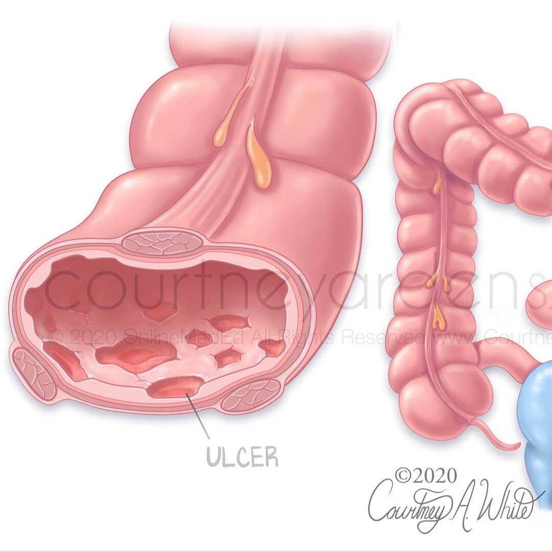 This medical illustration was designed for medical educational purposes to highlight the differences between ulcerative colitis and Crohn's disease, both of which are inflammatory bowel diseases (IBD). While Crohn's can cause inflammation anywhere in