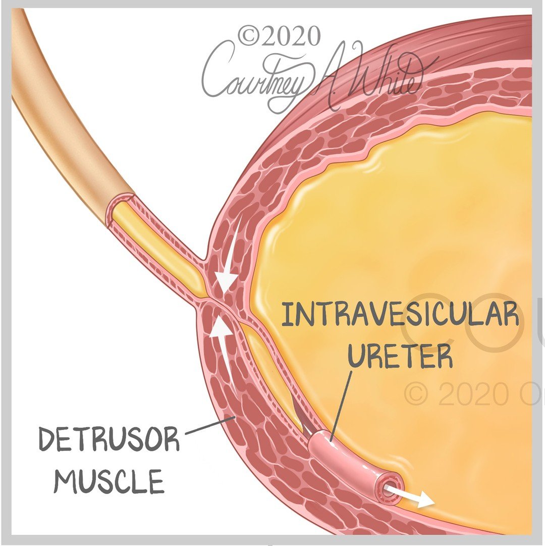 Vesicoureteral Reflex (VUR) is when urine flows backward from the bladder to the ureters and potentially to the kidneys. Normally, urine should flow from the kidneys, through the ureters, to the bladder. VUR can happen due to an abnormal vesicoureter