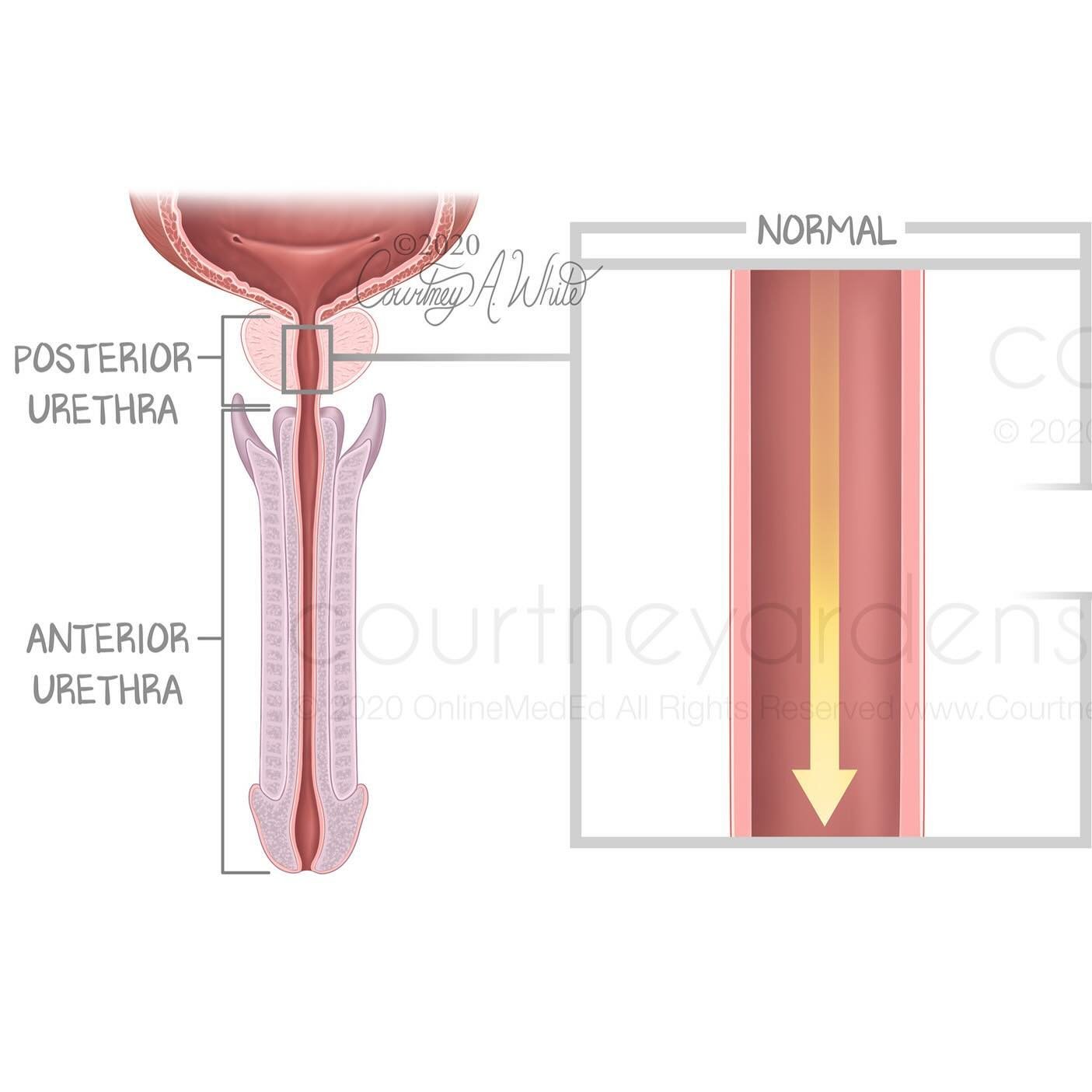 A posterior urethral valve (PUV) is a rare birth defect where a fold of tissue in the posterior part of the urethra obstructs the flow of urine. If urine isn&rsquo;t able to leave the body it can damage the urethra, bladder, ureters and kidneys. The 