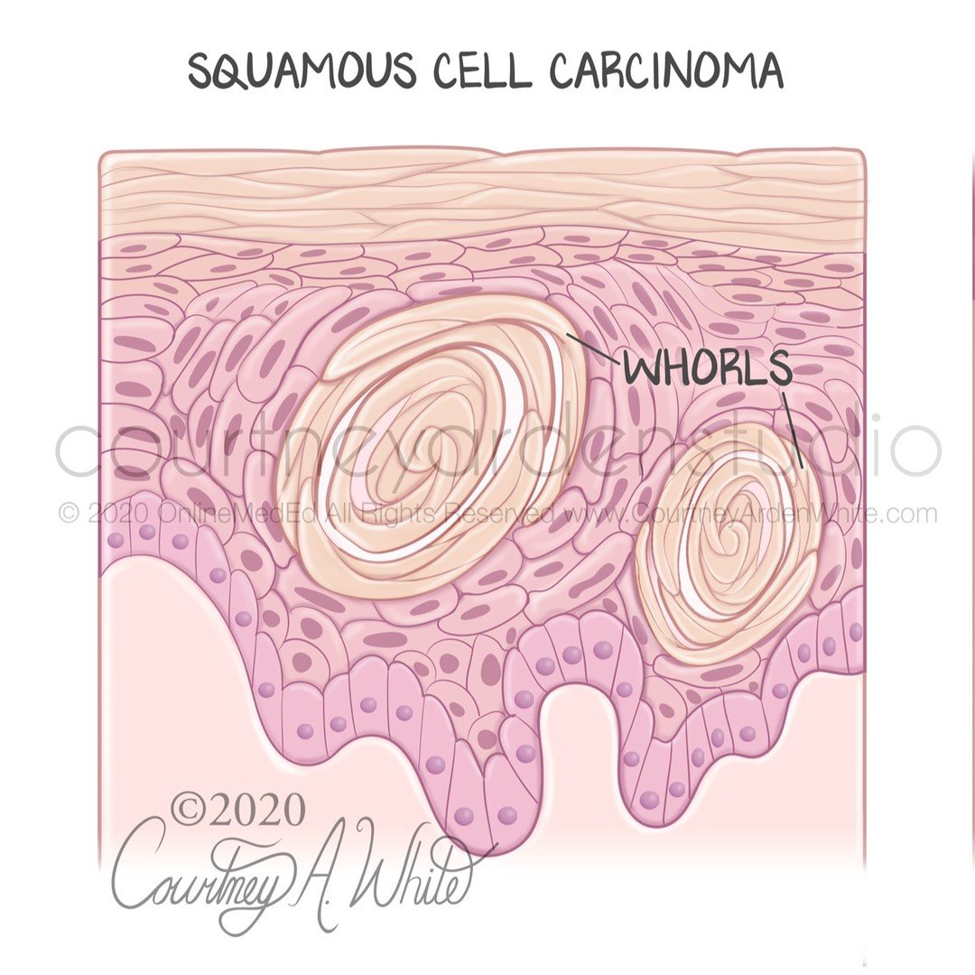 This illustration was created for medical education about the histological characteristics of skin cancer as seen under the microscope. The three major types are squamous cell carcinoma, basal cell carcinoma, and Melanoma. Squamous cell carcinoma is 