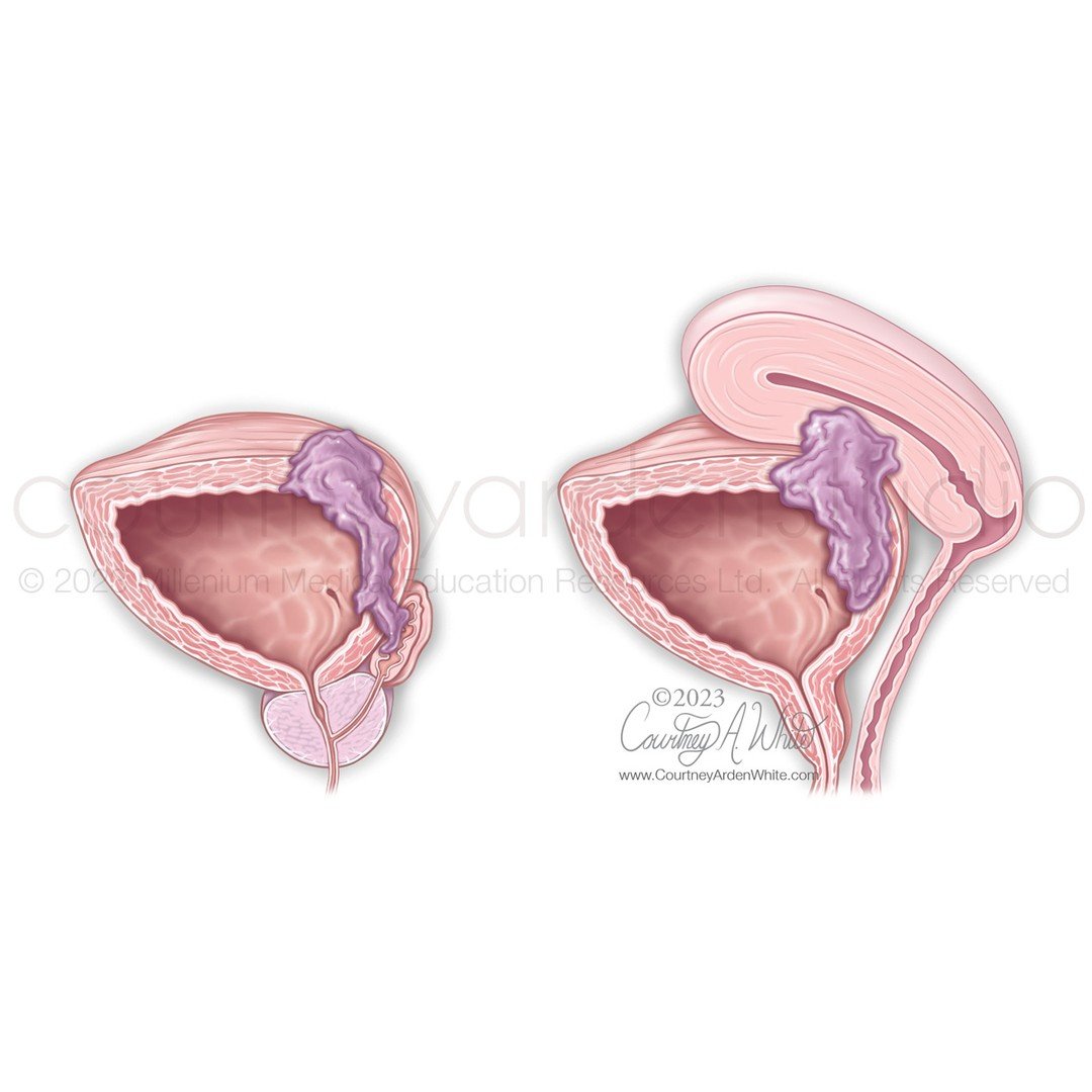 These illustrations were part of the patient education flip book I posted about last week. They focus on the staging of bladder cancer and tumor appearance. Bladder cancer has four stages. Each stage is determined by the extent to which the cancer ha