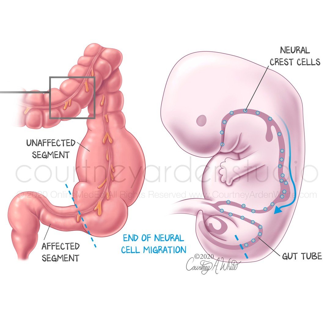This illustration is about Hirschsprung disease (HSCR,aganglionic megacolon), a congenital disease that affects the colon. During development, the neural crest cells cease migrating, preventing nerves from forming in part of the colon (large intestin