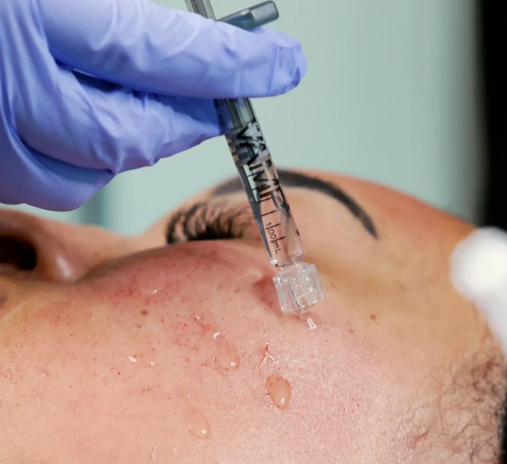 Salmon DNA Facial hero — SkinPen microneedling plus VAMP PDRN infusion in Ponte Vedra