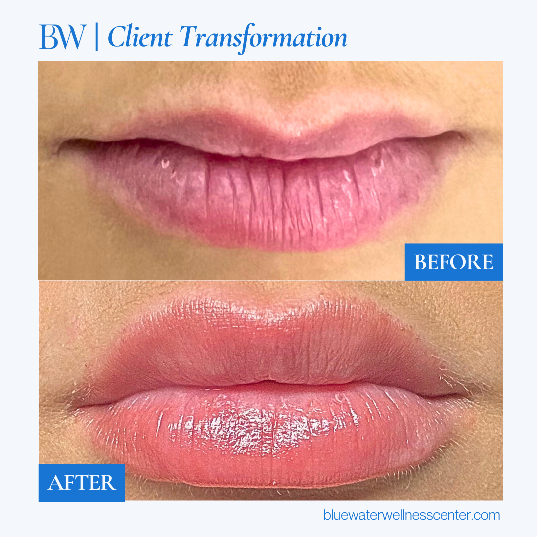 Close-up of lips before and after cosmetic treatment showing improved lip fullness and smoothness, with the top image labeled 'BEFORE' and the bottom labeled 'AFTER'.