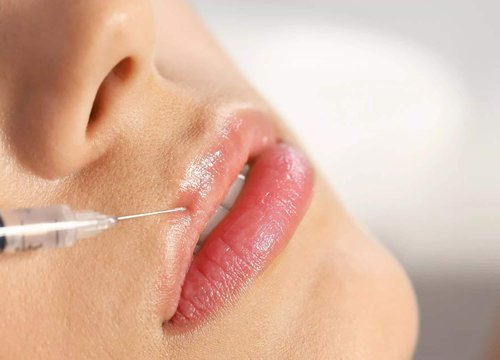 Lip Filler Ponte Vedra
