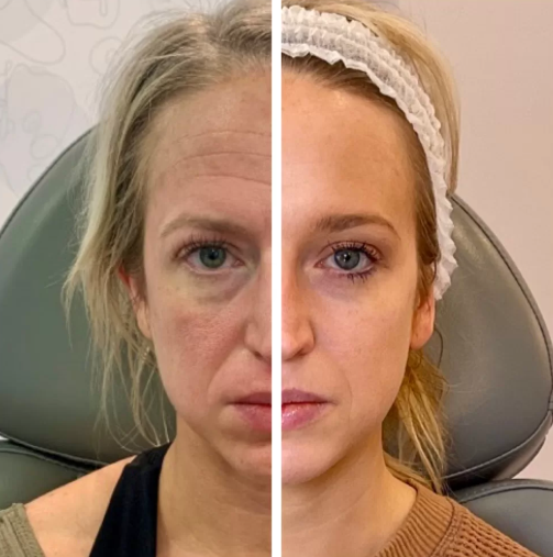 Subtle, gradual volume restoration with Sculptra near Jacksonville, FL