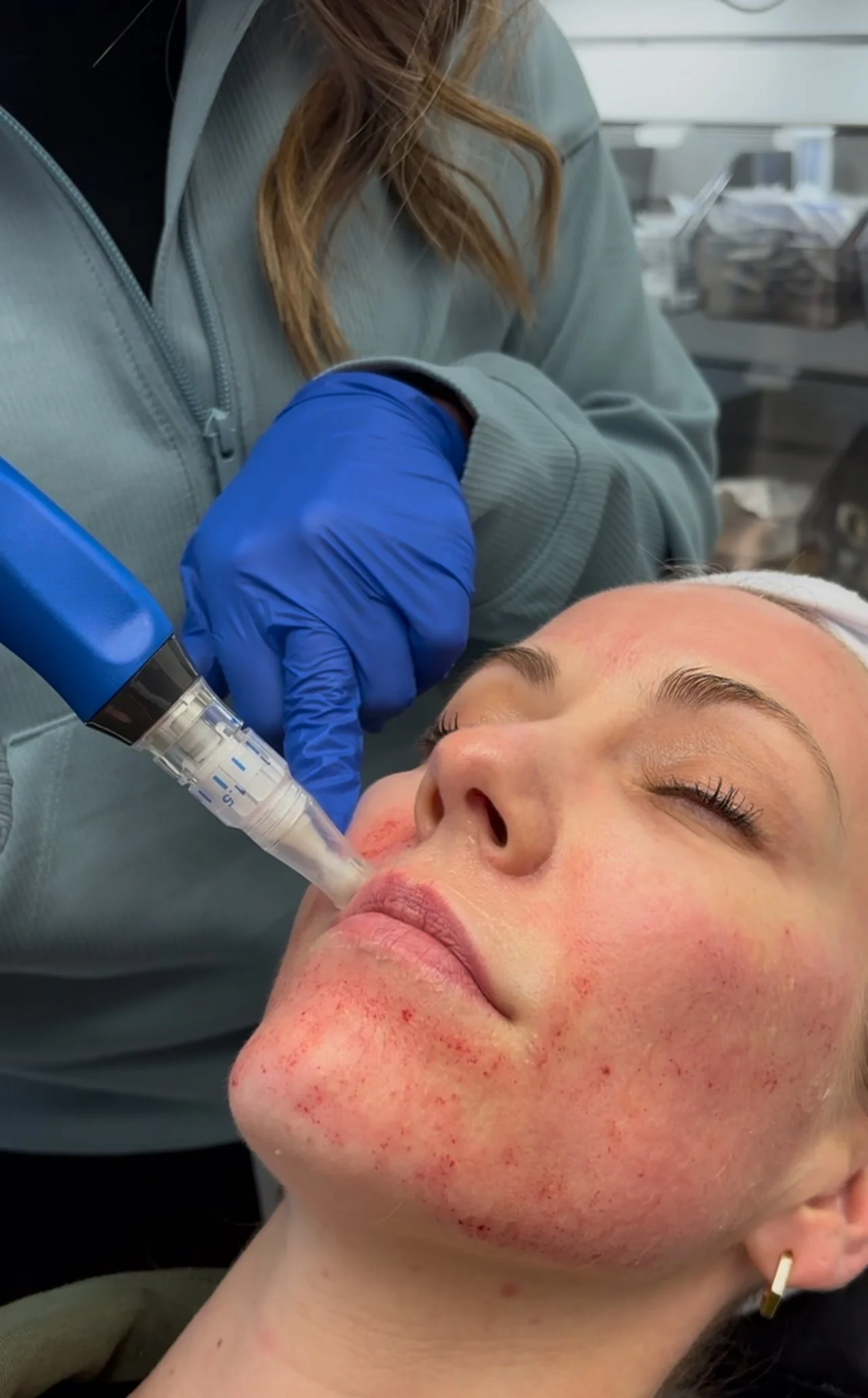 Microneedling in Ponte Vedra - treatment close-up