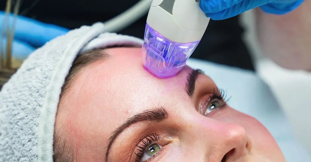 RF microneedling near me in Ponte Vedra — skin tightening & texture smoothing
