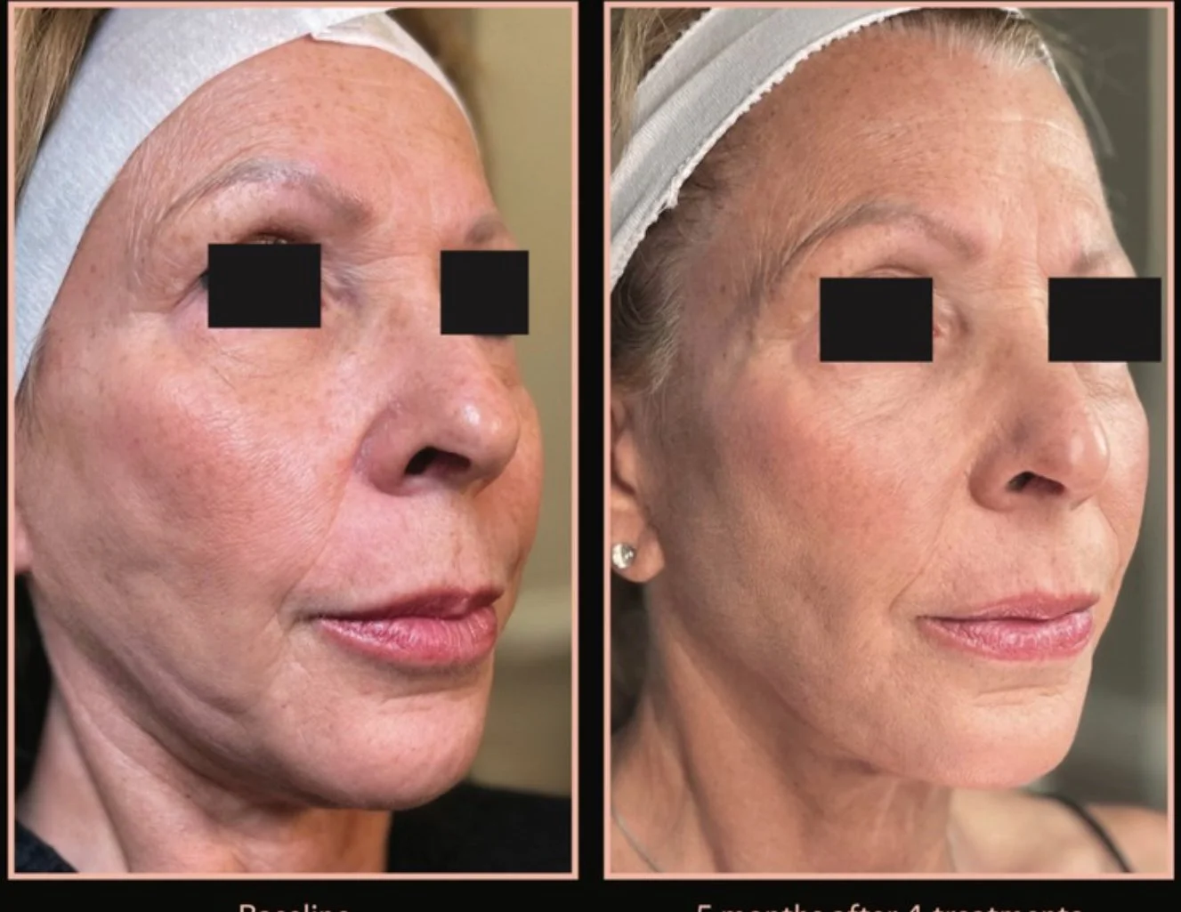 How to Tighten Loose Skin After Weight Loss in Jacksonville