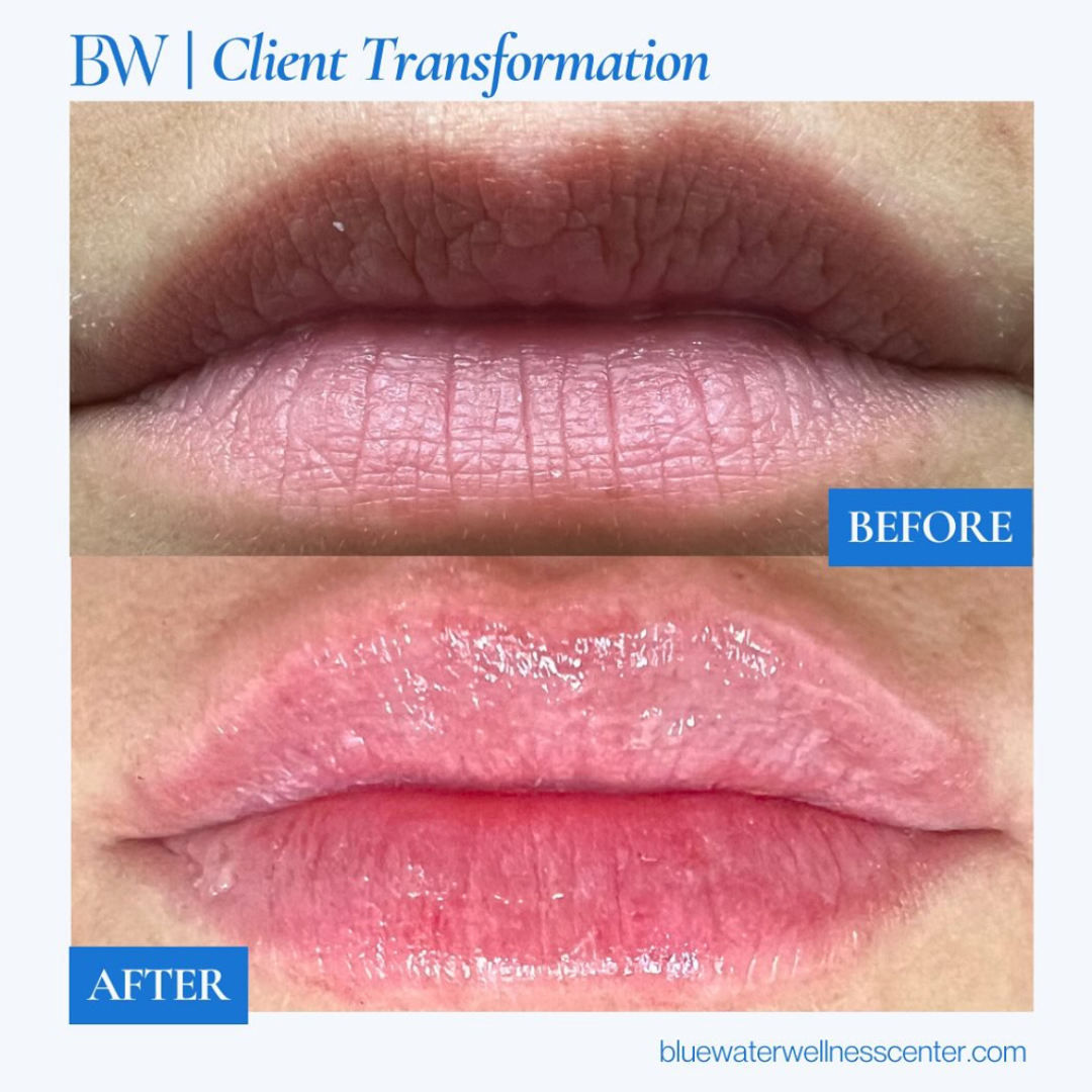 Comparison of lips before and after treatment showing significant moisture and smoothness improvement, with the top image labeled 'Before' and the bottom 'After'.