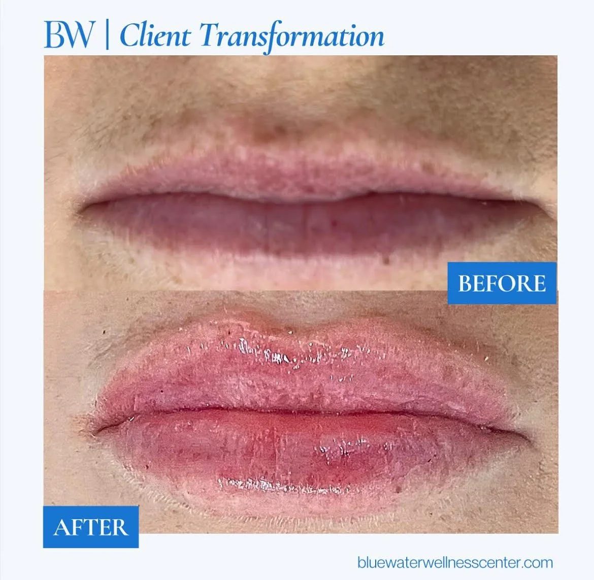 Before and after images of lips showing improvement after a client transformation at Blue Water Wellness Center.