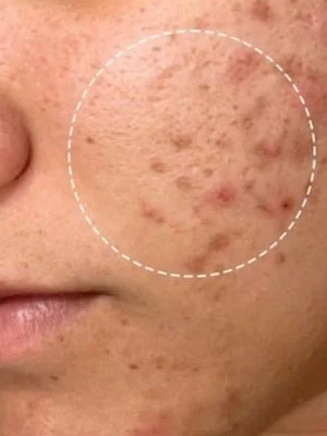 Before and after HydraFacial results showing glowing skin