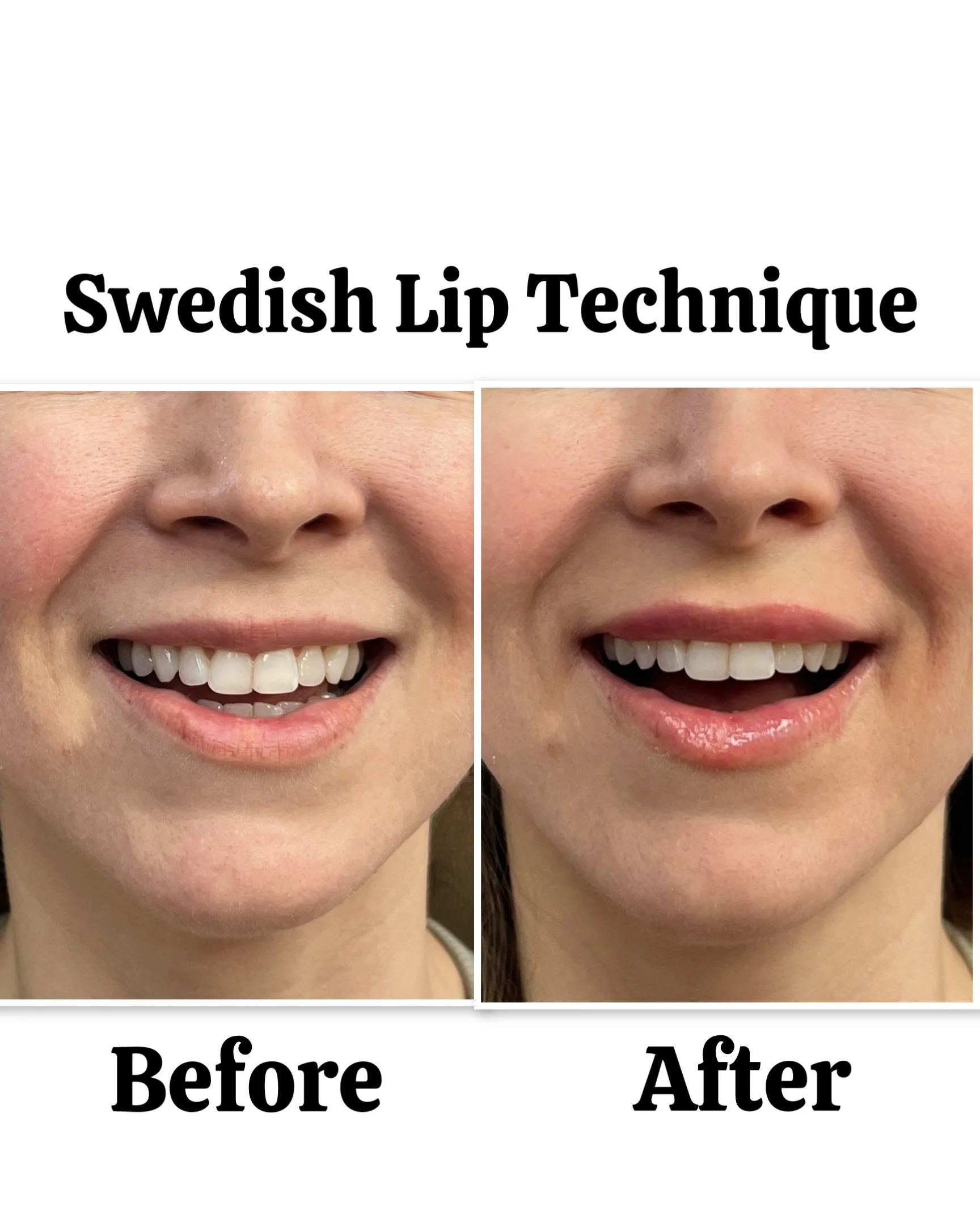 swedish-lip-technique-results-point-loma-03.jpeg