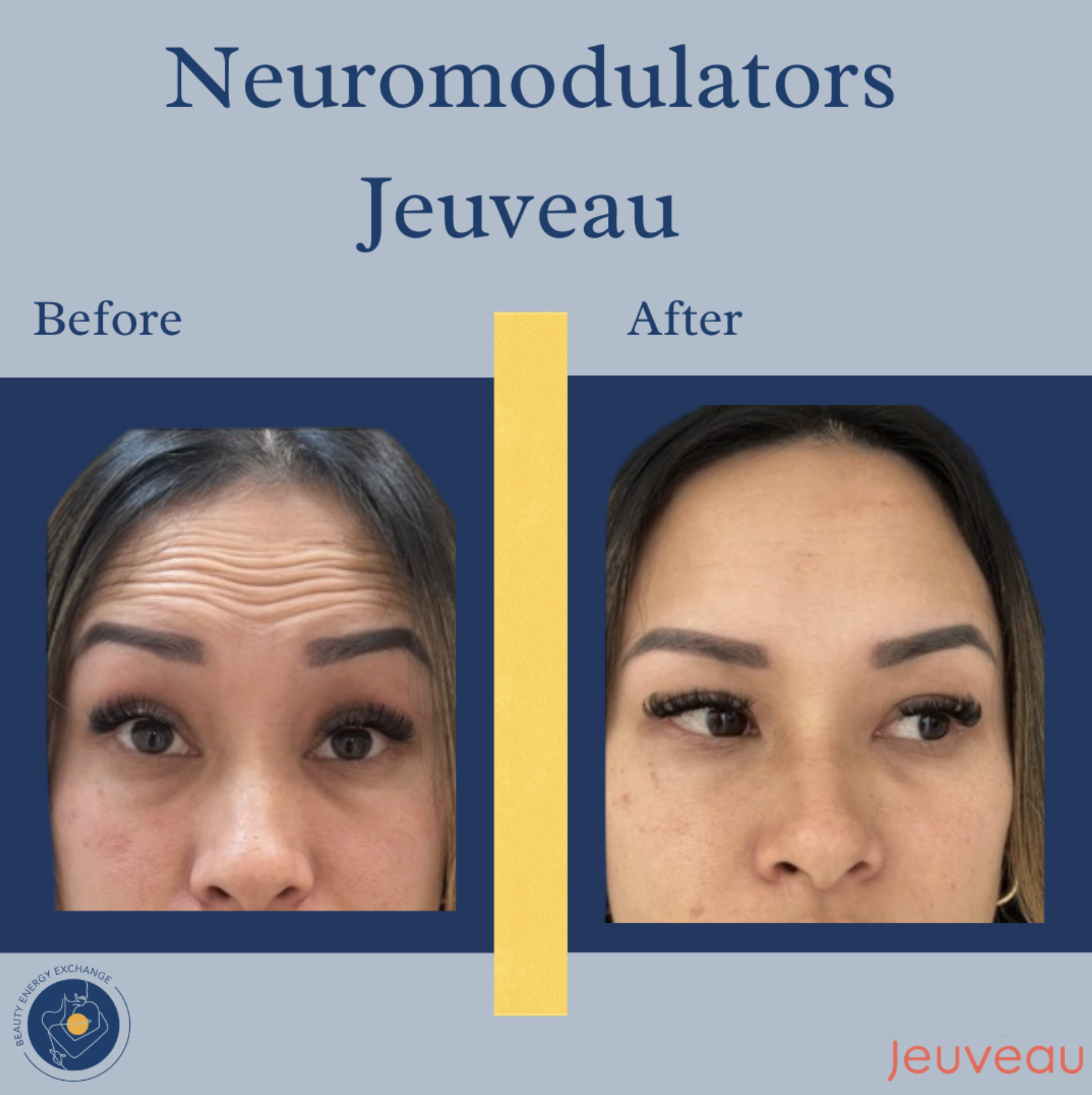 Neuromodulators-Jeuveau-before-after.png