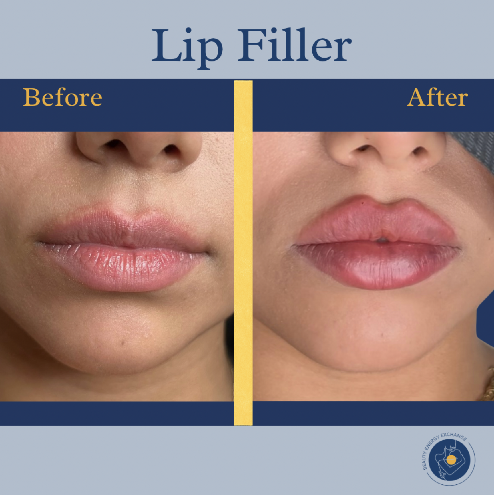 Russian lip filler San DIego.png
