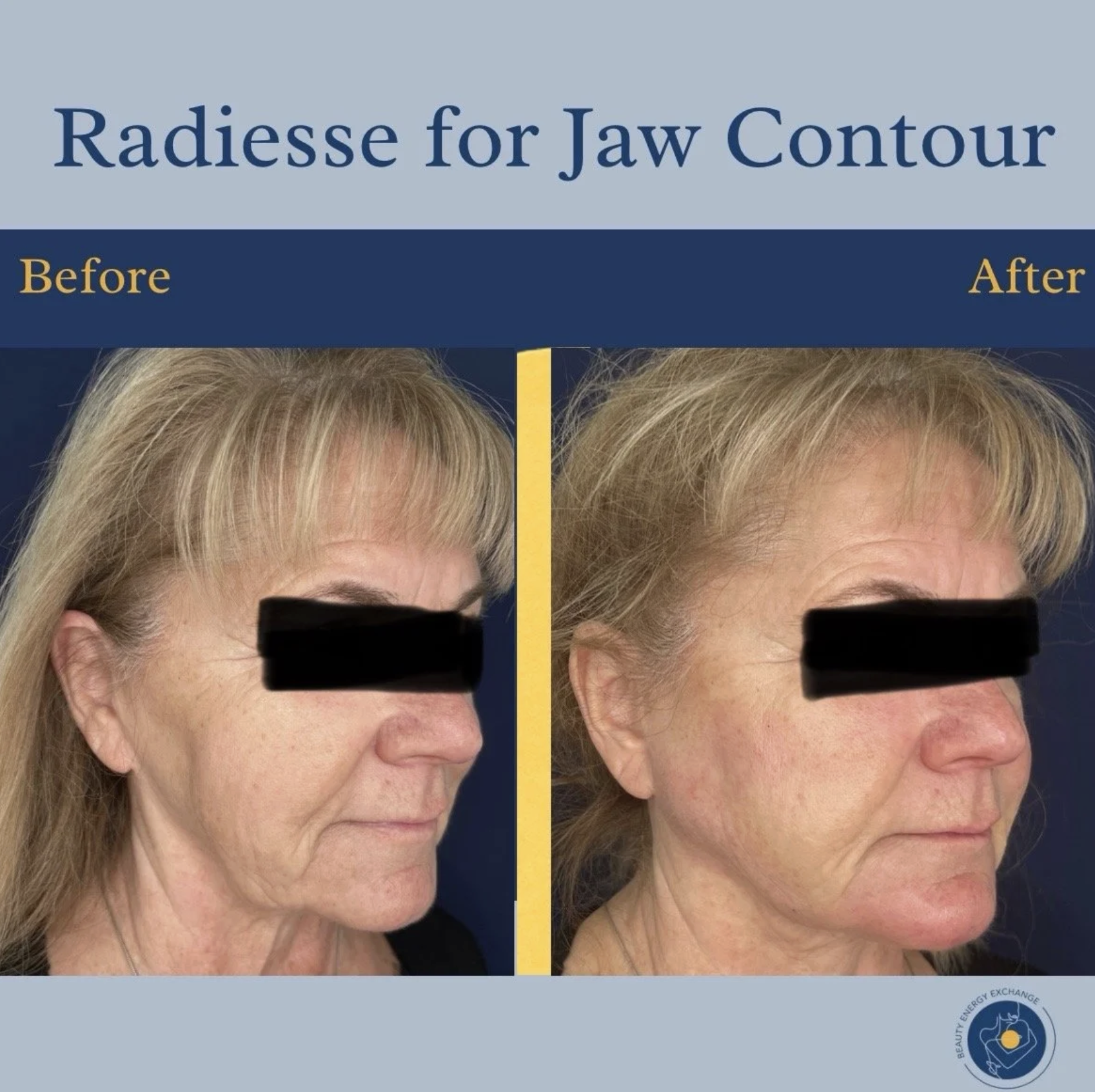 jawline filler Ocean Beach