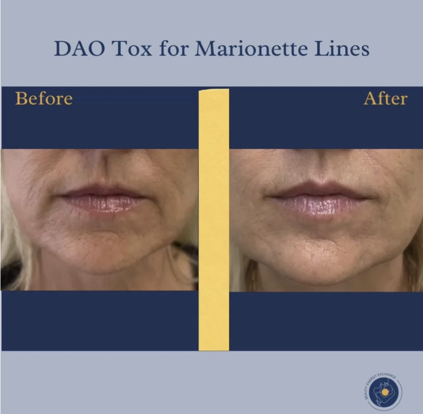DAO-Tox-for-Marionette-Lines.png
