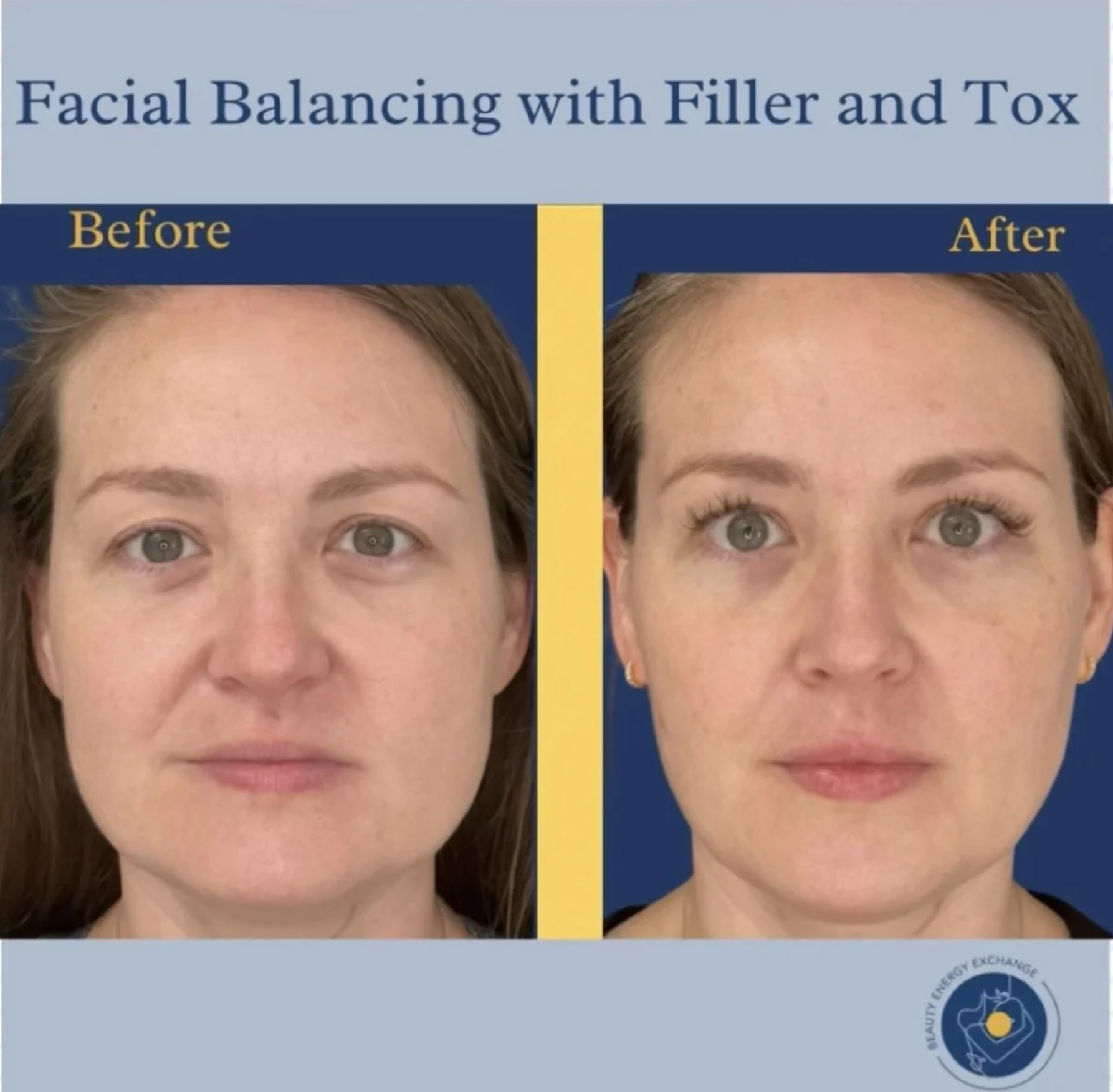 facial-balancing-filler-san-diego-before-after.png