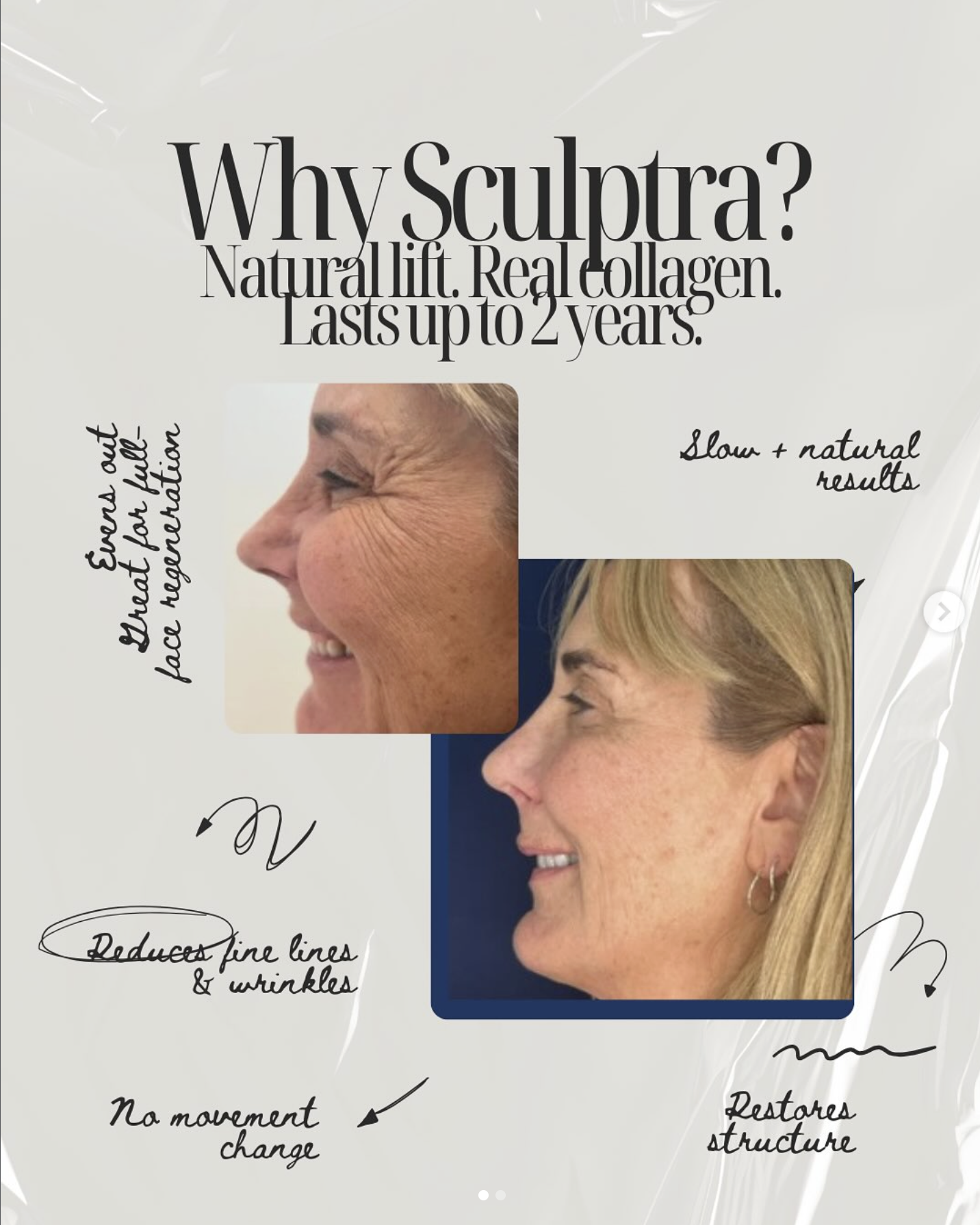 before and after photo of sculptra