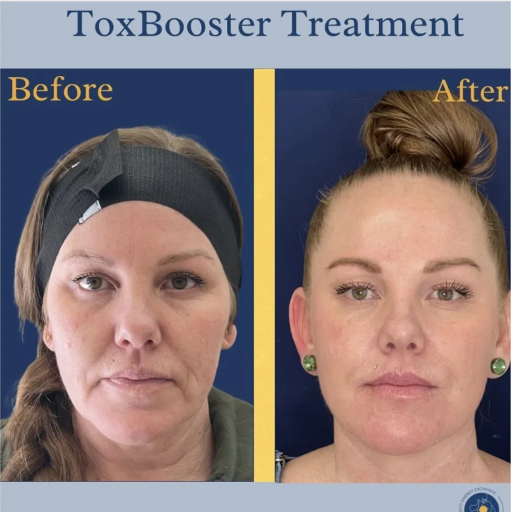 before and after photo of botox in San Diego