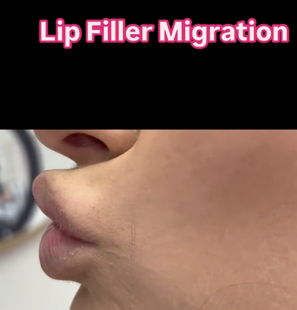 over filled lips - lip filler migration