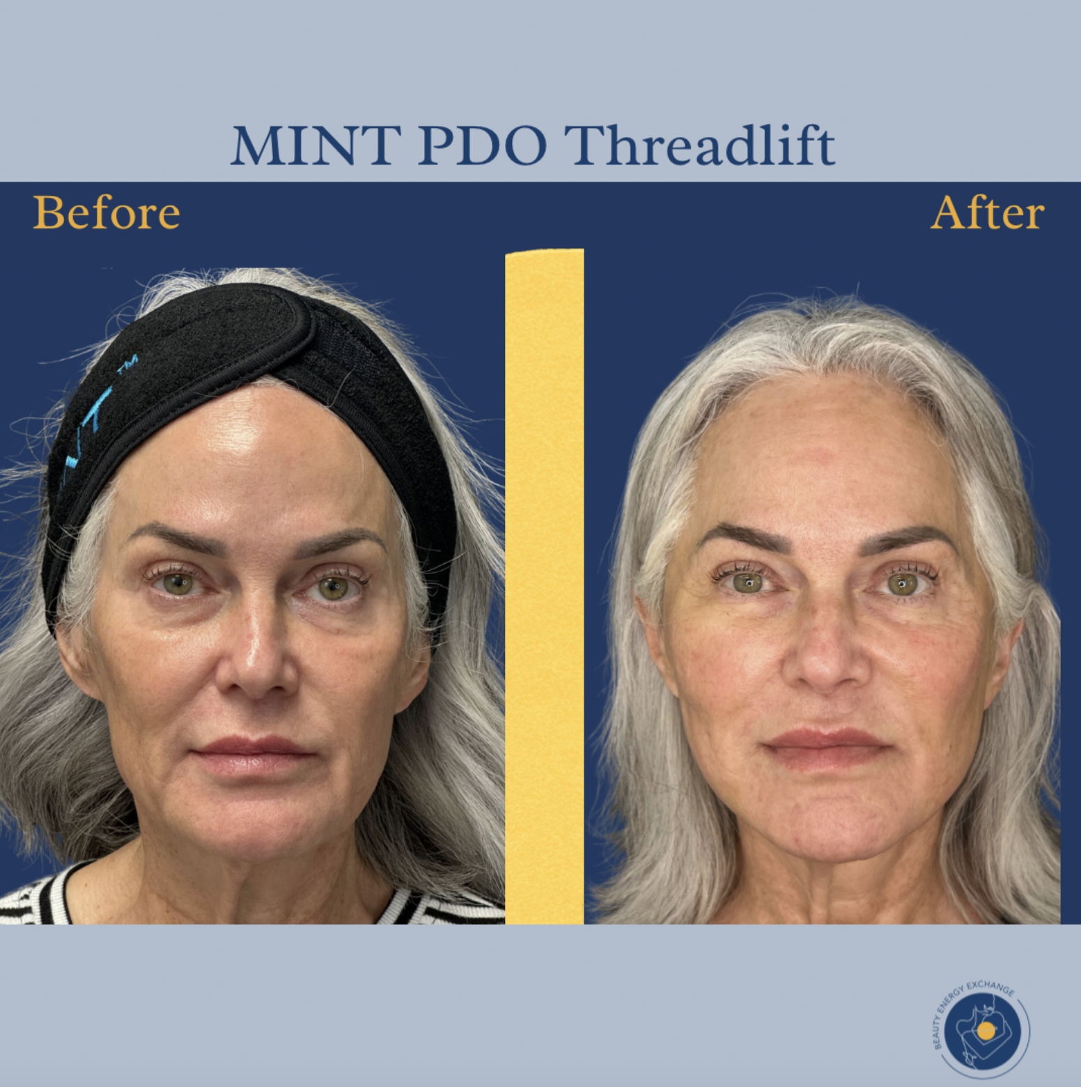 face lifted from a PDO thread lift