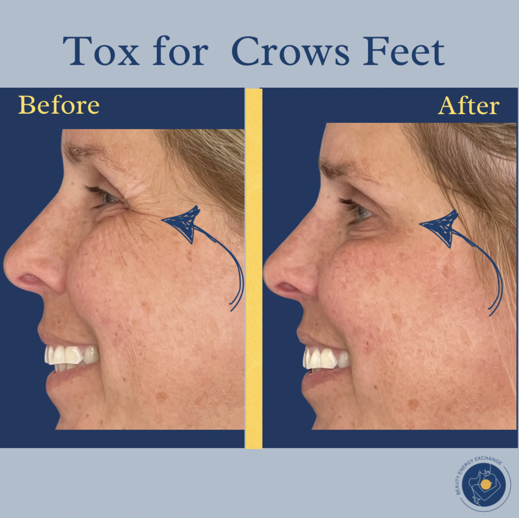 crows-feet-before-after.png