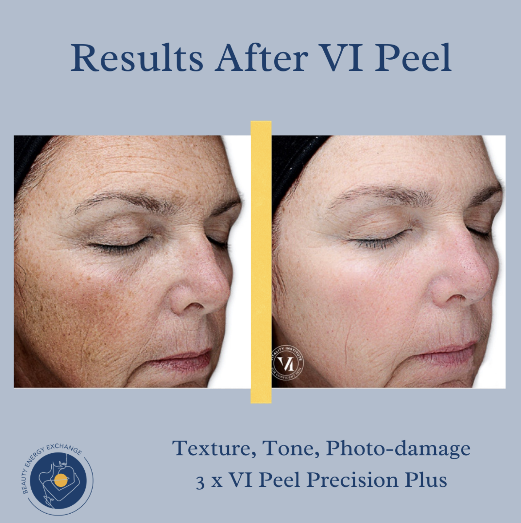 before and after peel in Ocean Beach