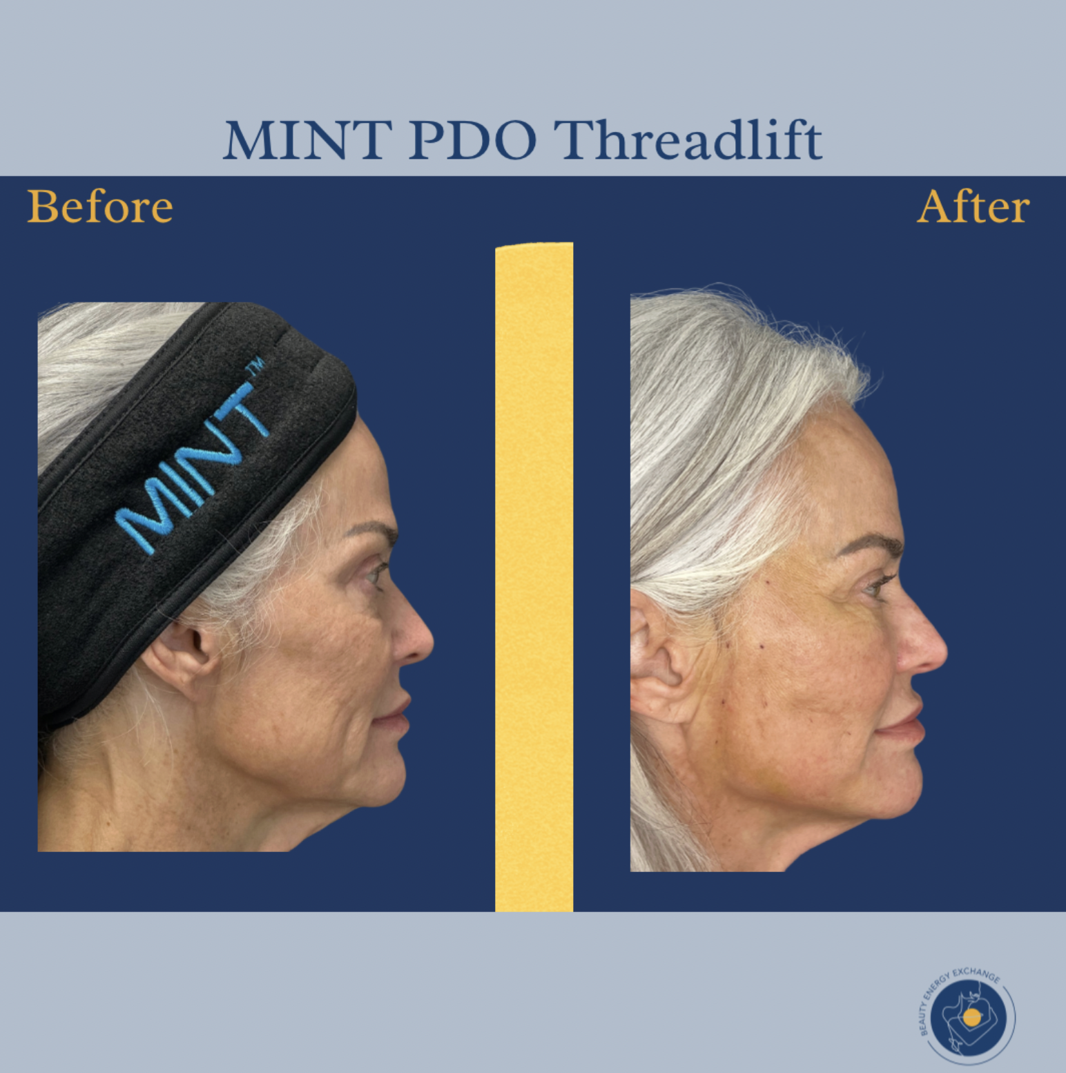 PDO thread lifts in Ocean Beach before and after