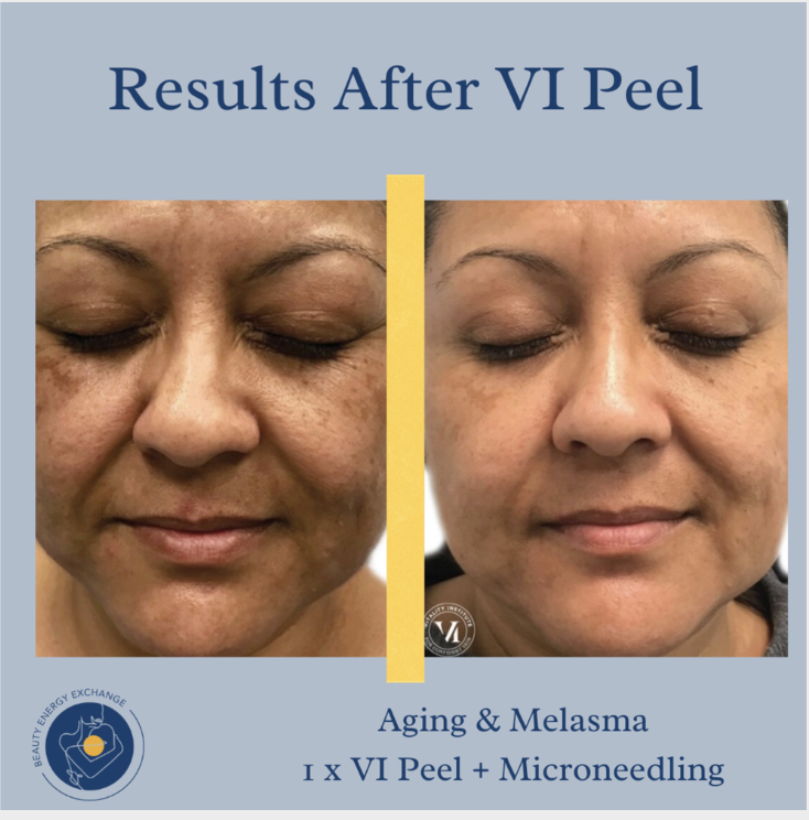 chemical peels vs microneedling
