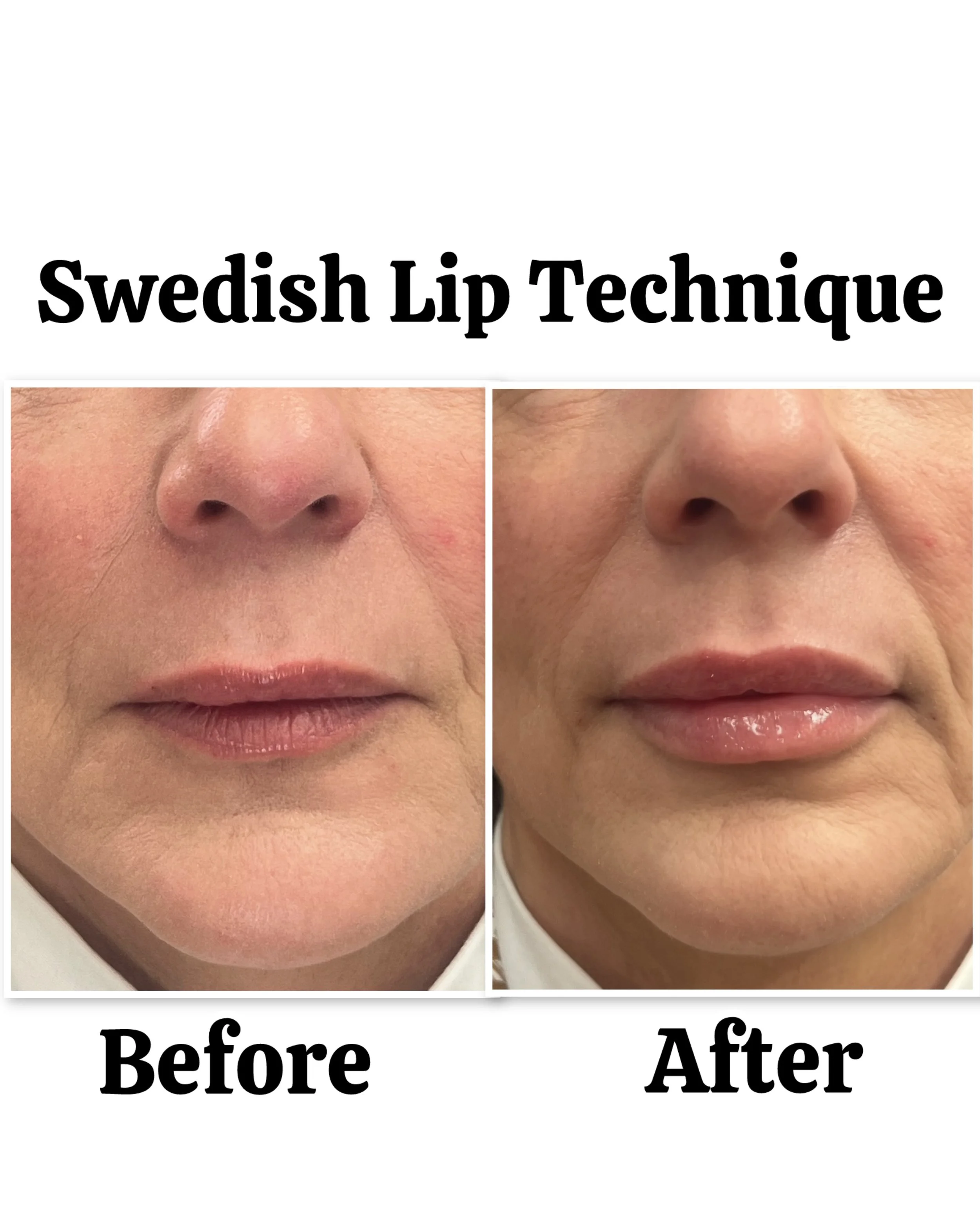 swedish-lip-fillers-point-loma-01.jpeg