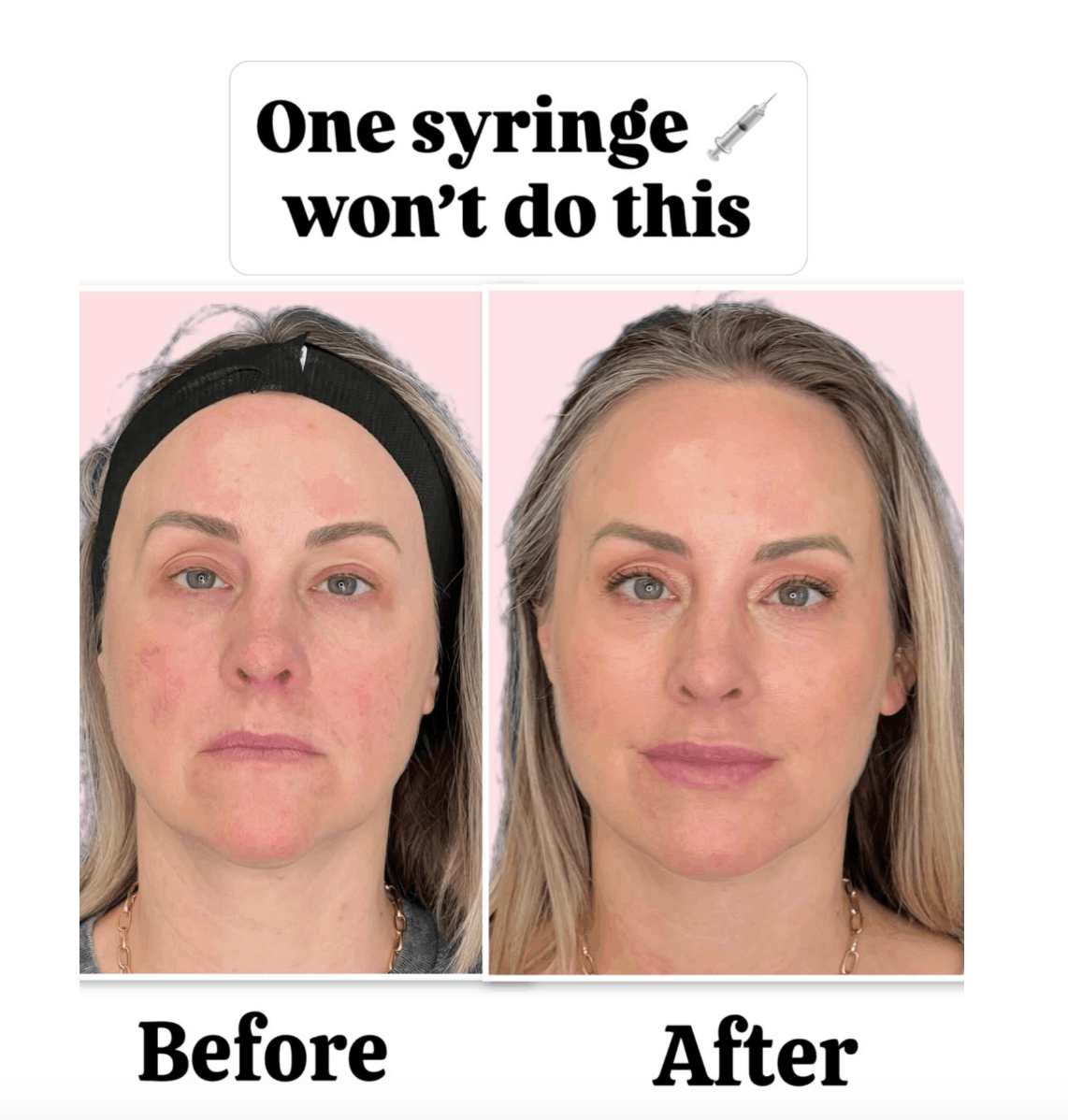 before and after results realistically need more than 1 syringe for these results