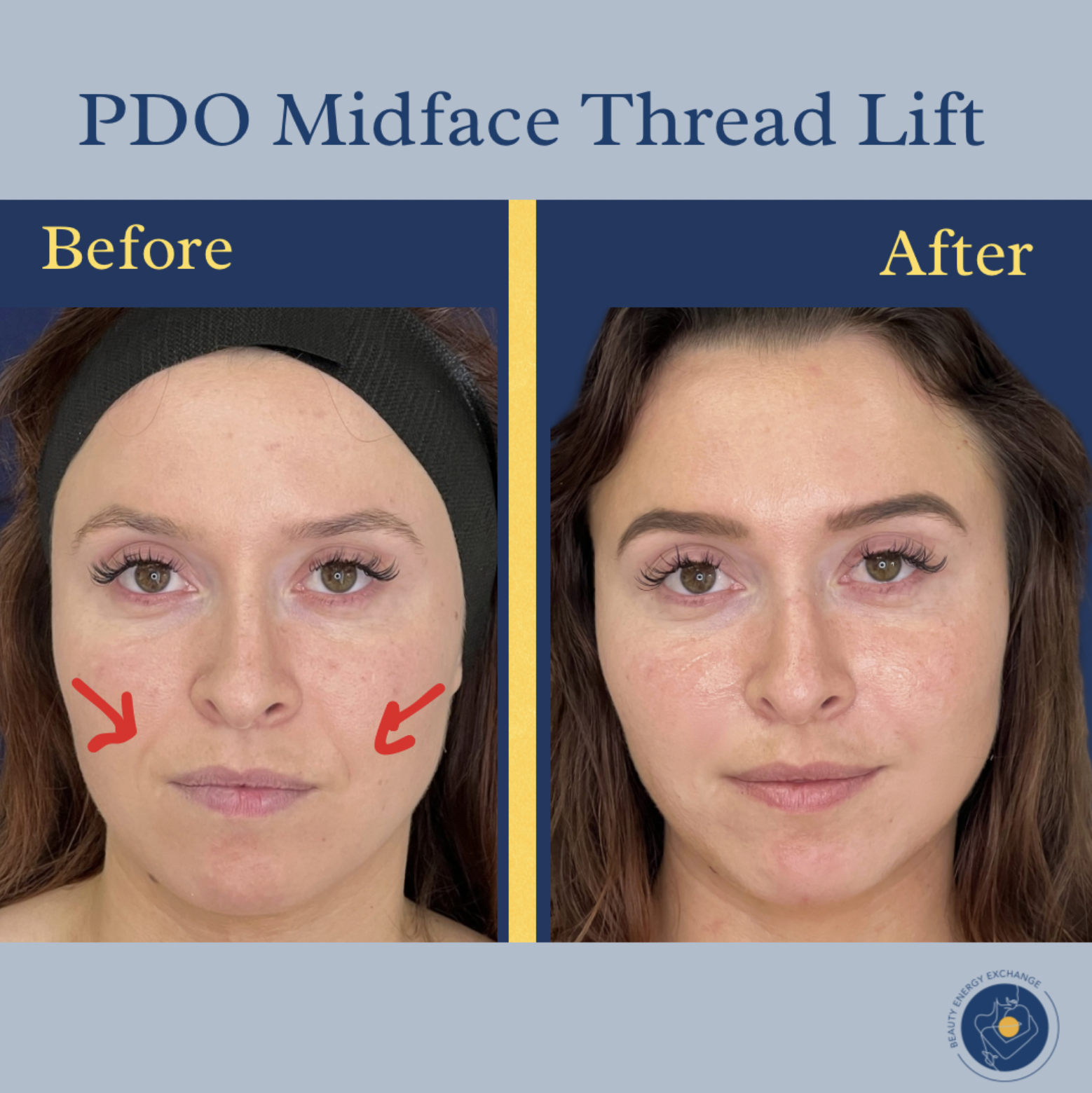 PDO Thread Lifts Ocean Beach (OB)