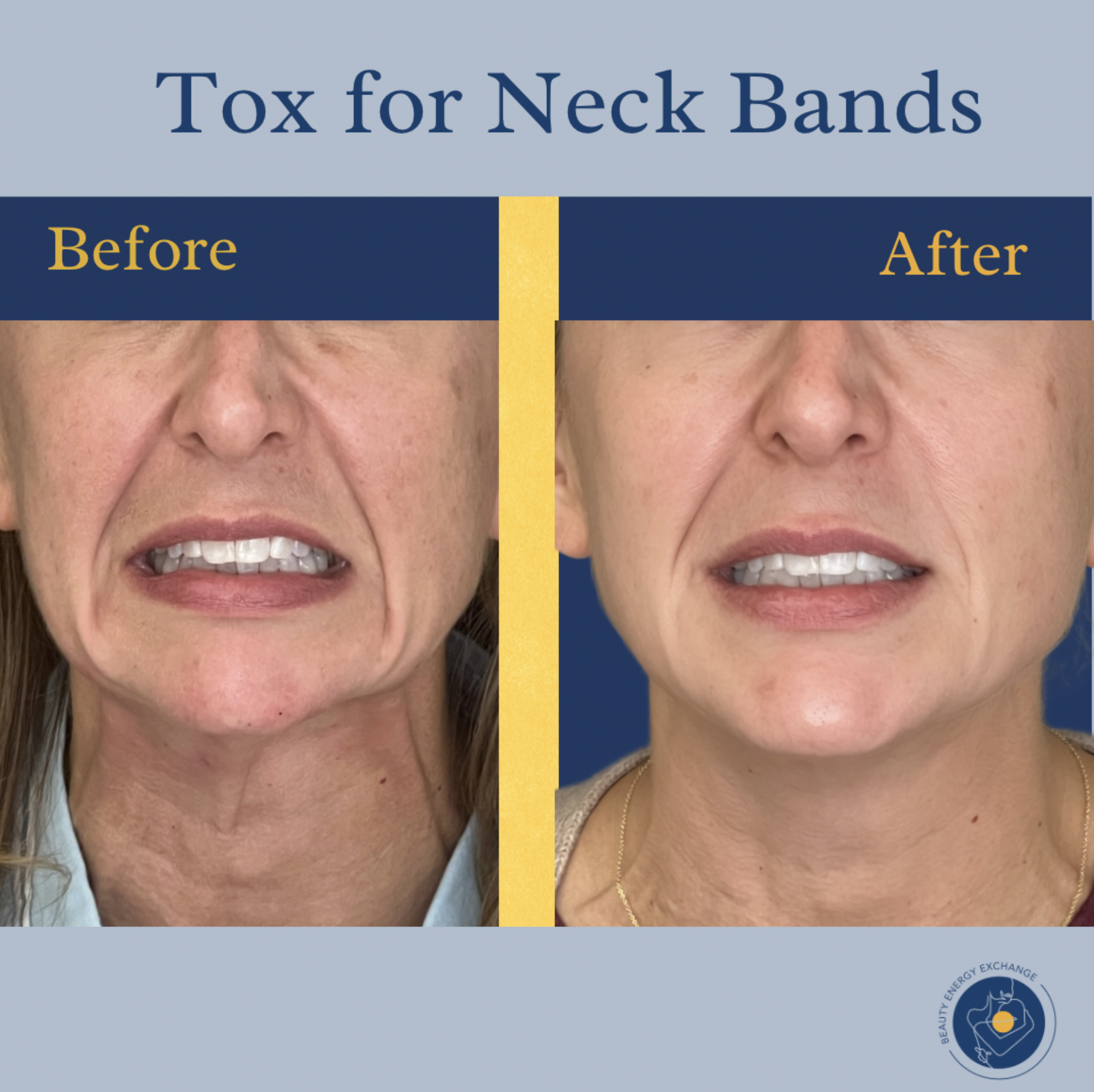 botox-neck-bands-san-diego.png