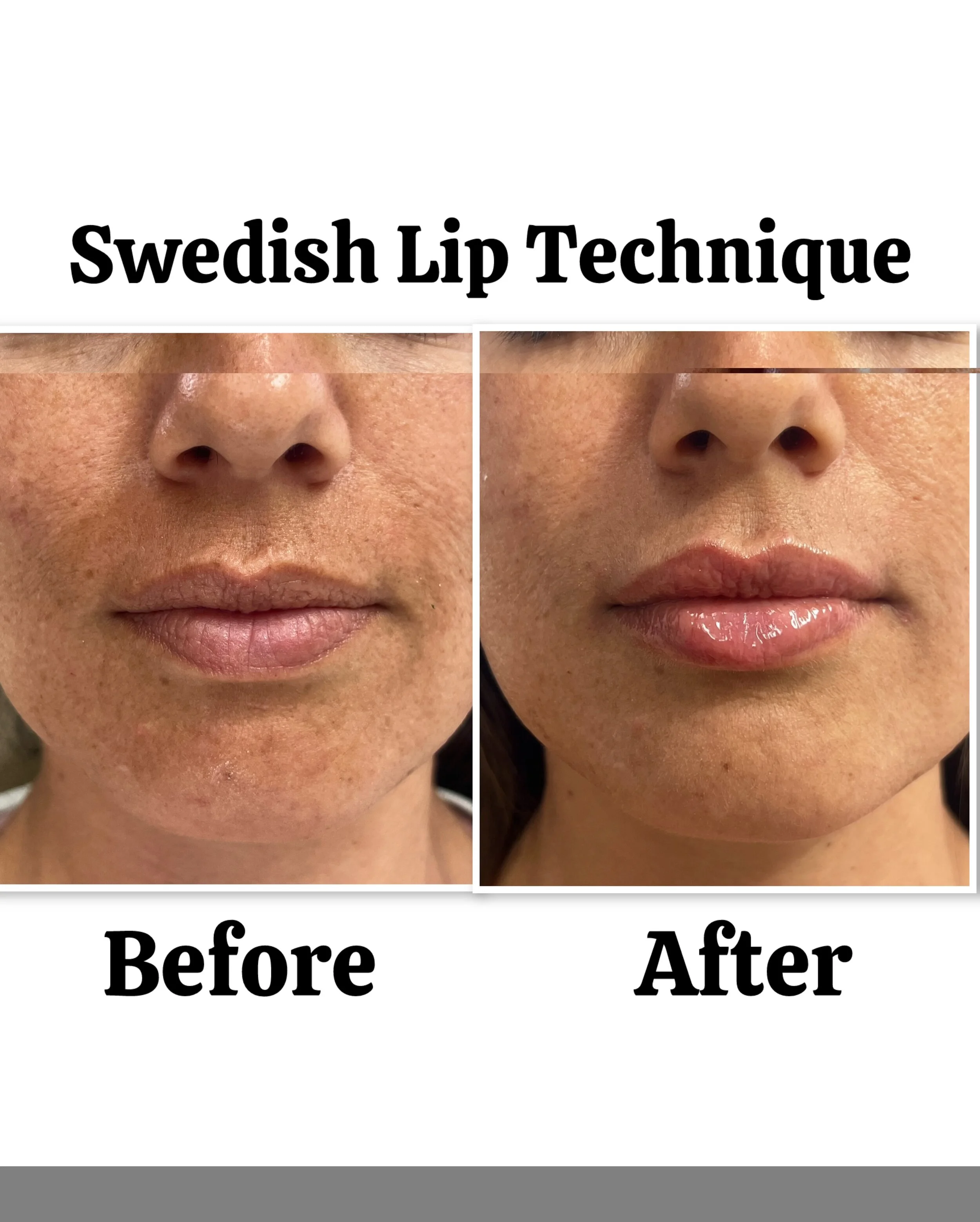natural-lip-augmentation-san-diego-02.jpeg