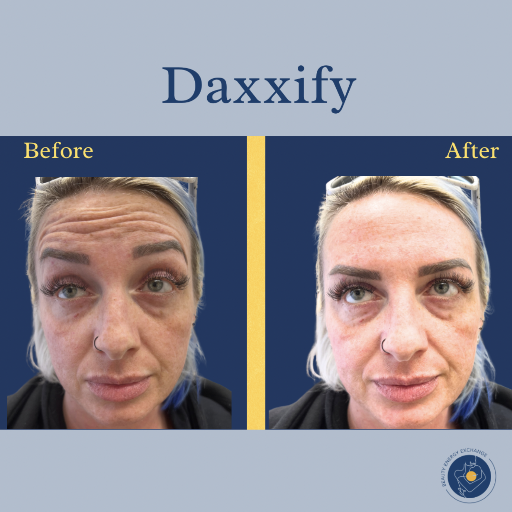 daxxify-before-after-san-diego.png