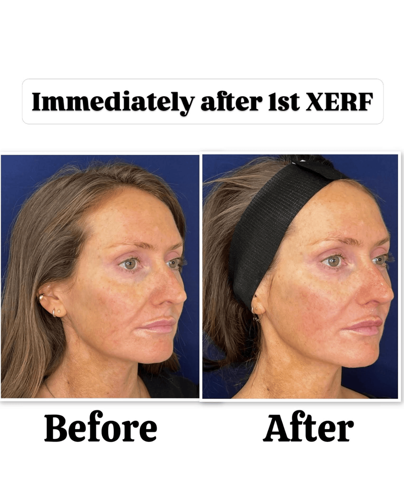 XERF before after in San Diego